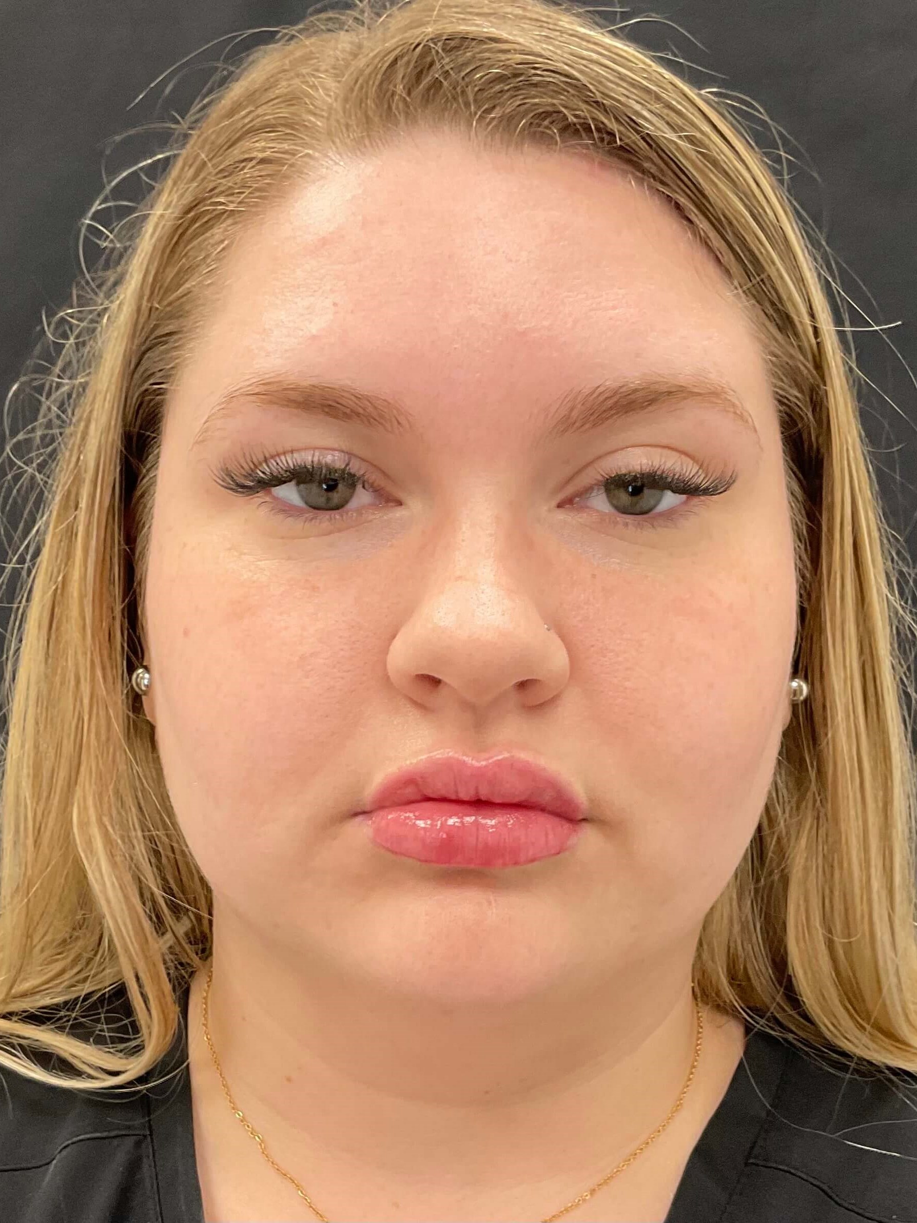 Lip filler After