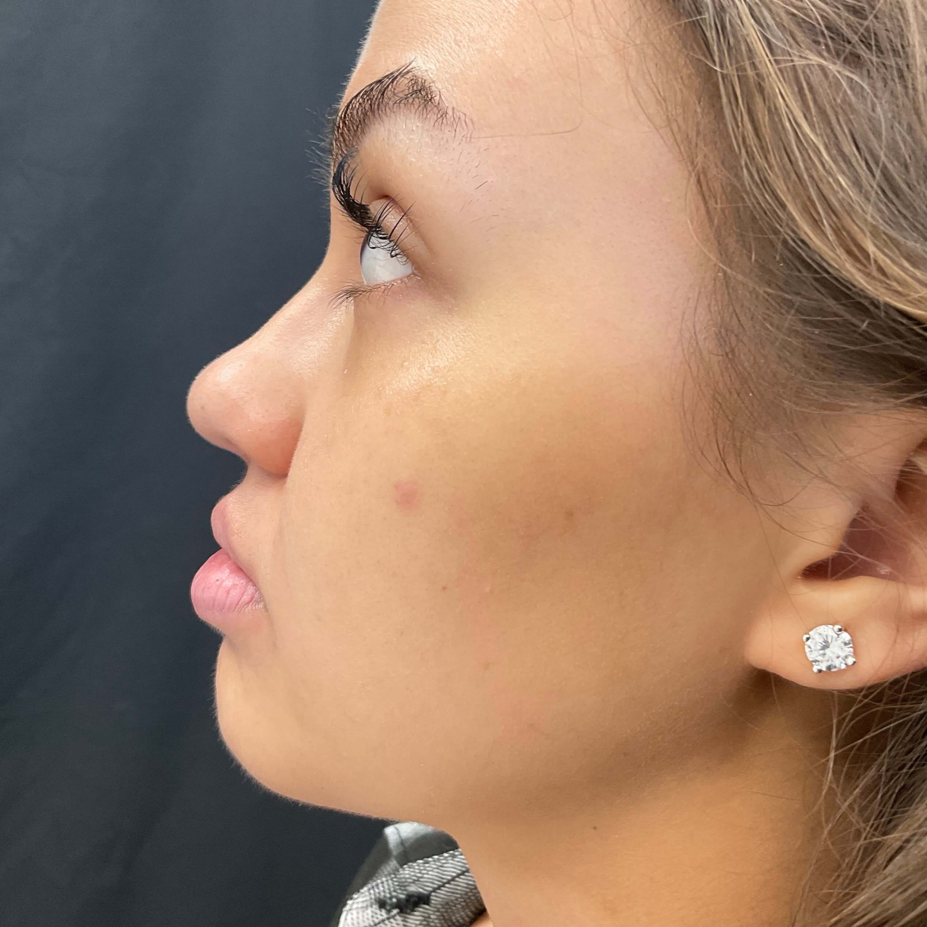 Lip filler Before
