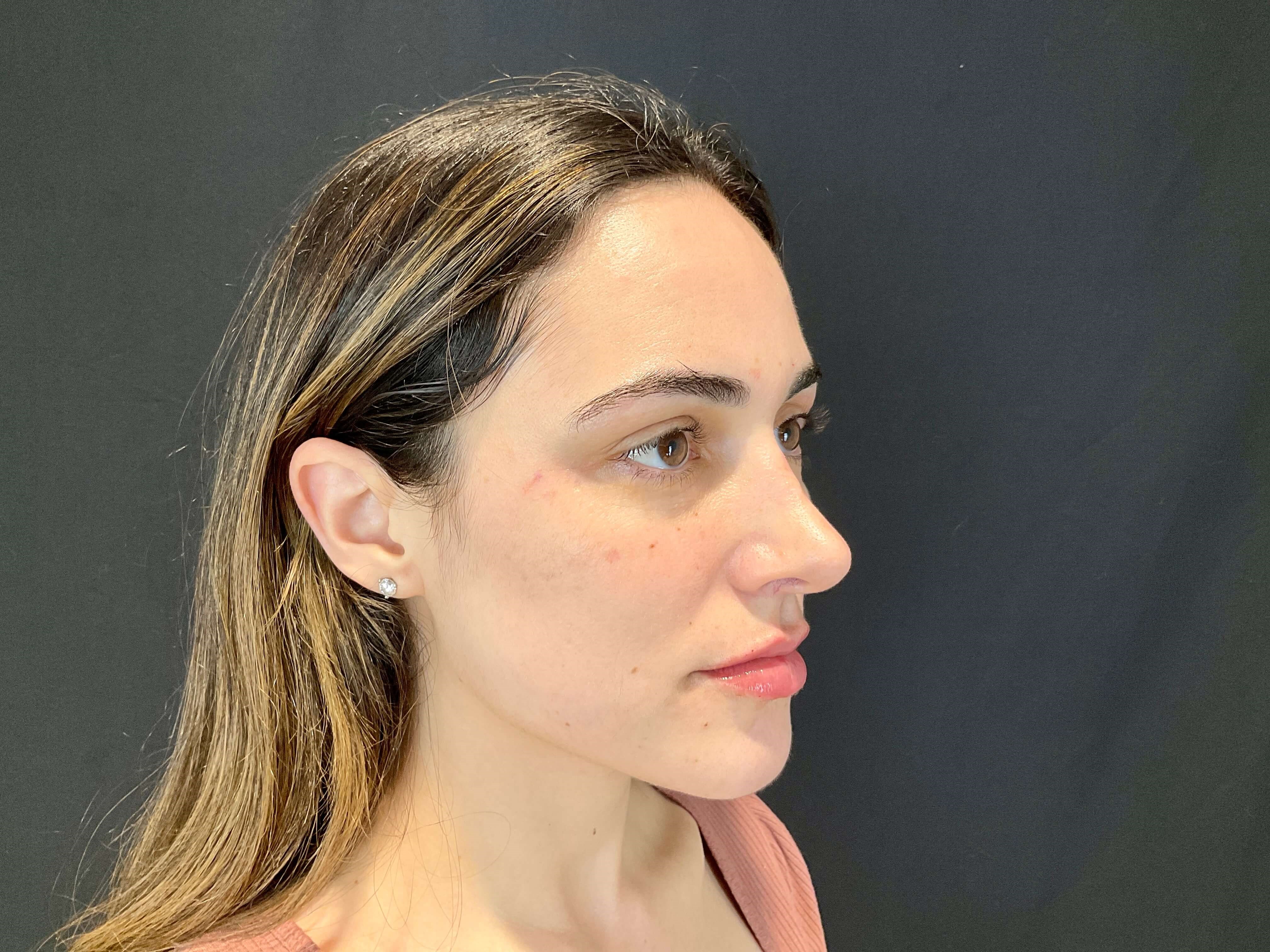 Lip filler After