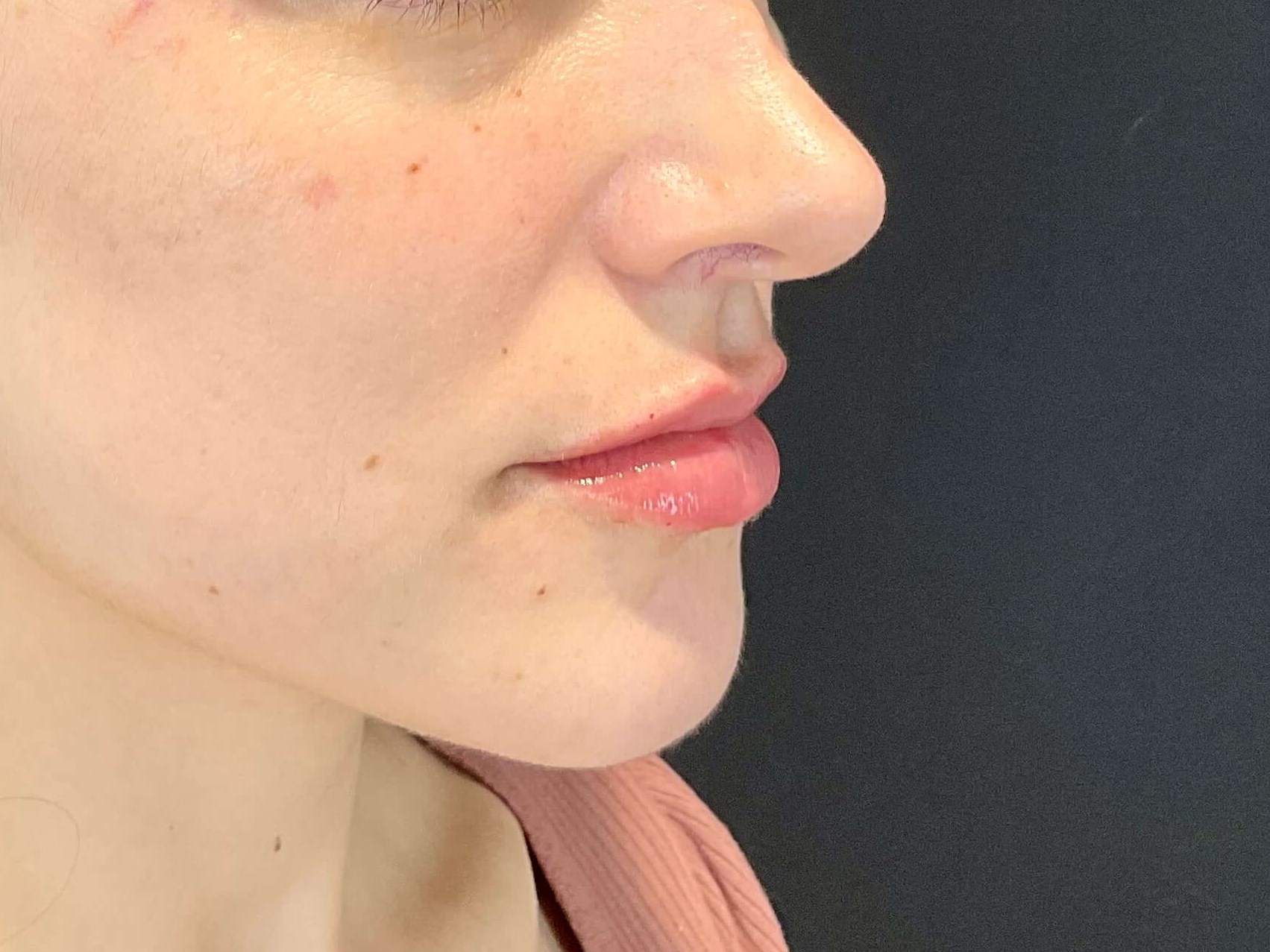 Lip filler After