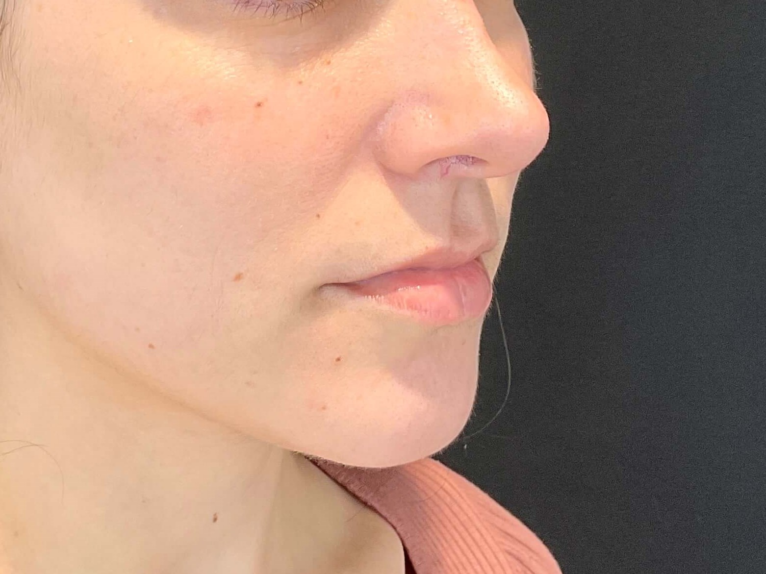 Lip filler Before