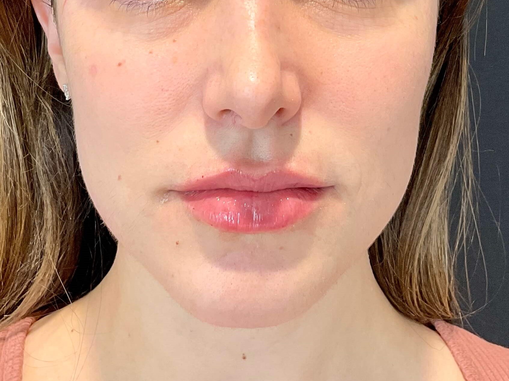 Lip filler After