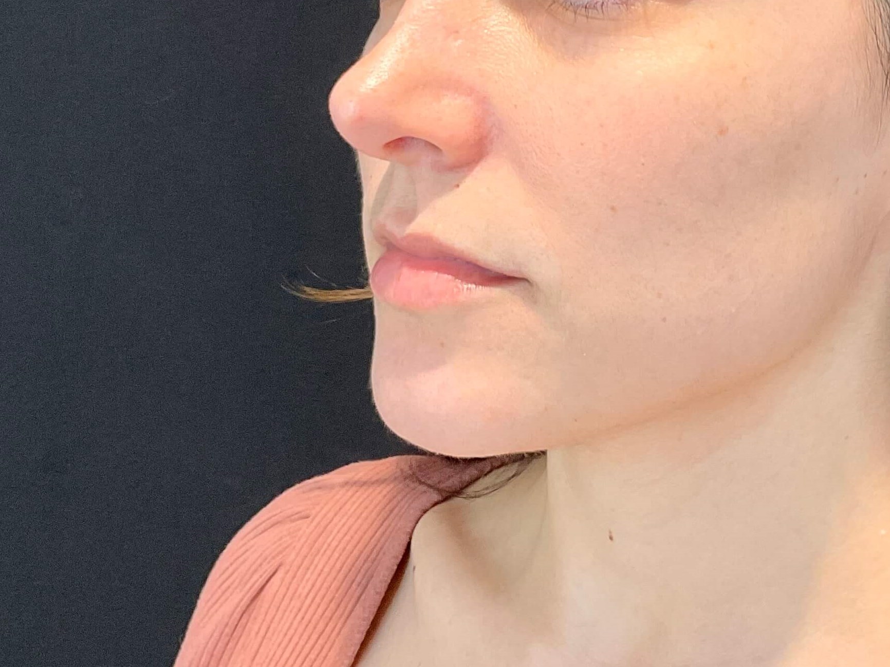 Lip filler Before