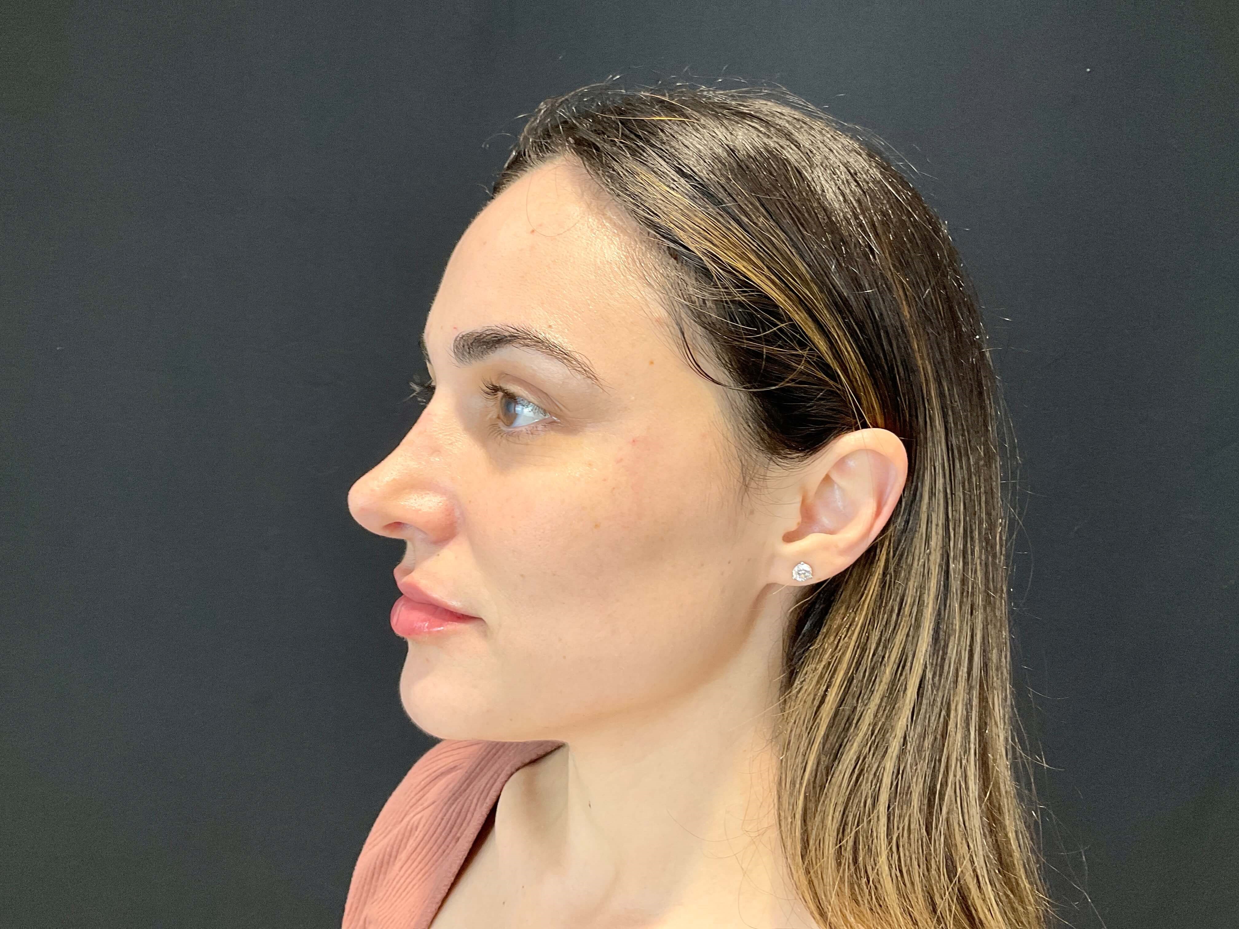 Lip filler After
