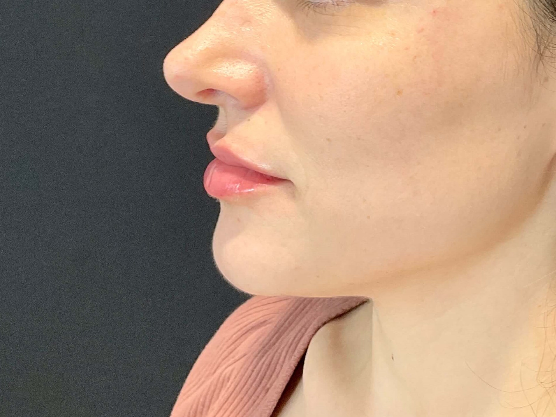 Lip filler After