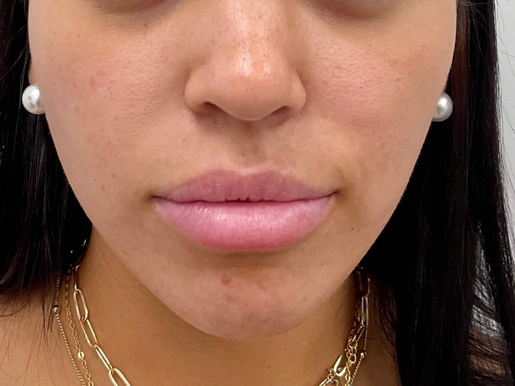 Lip filler Before