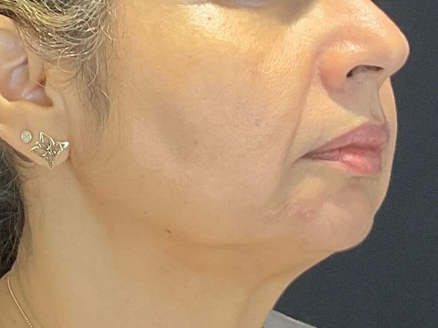 Sun spots, Hyperpigmentation After