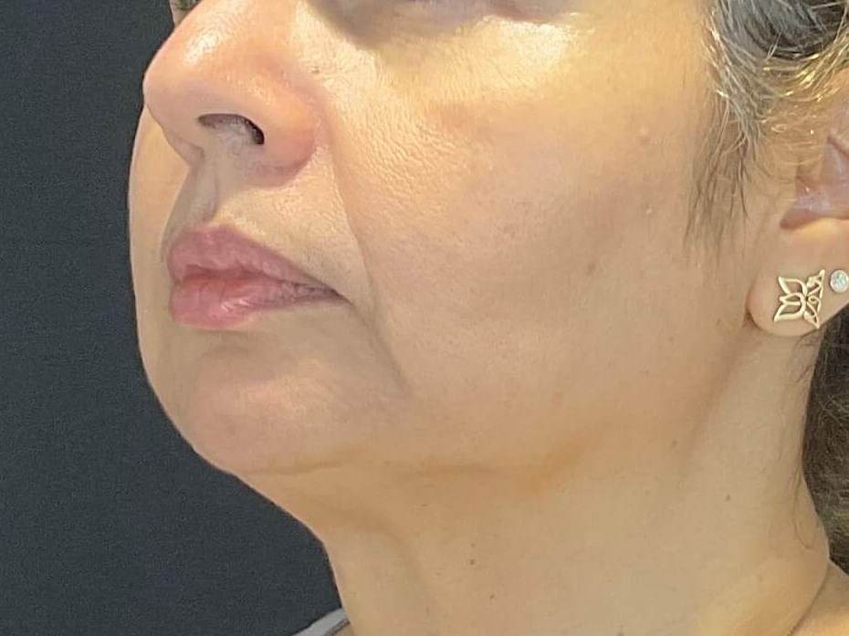 left side After