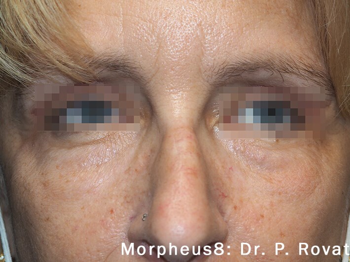 Morpheus8 After