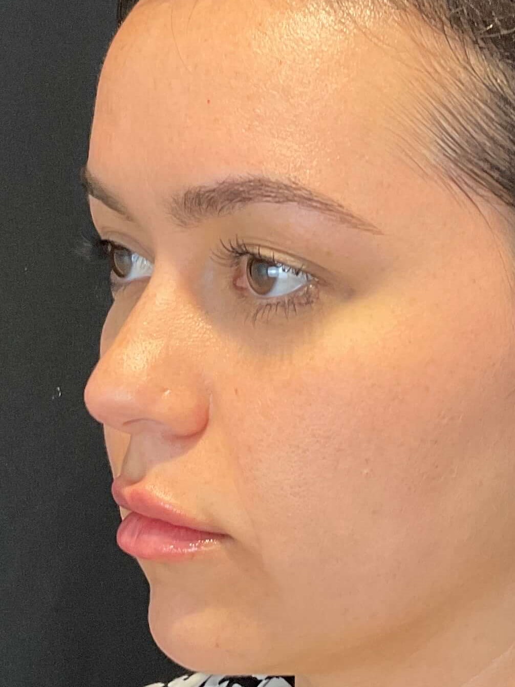 Lip filler After