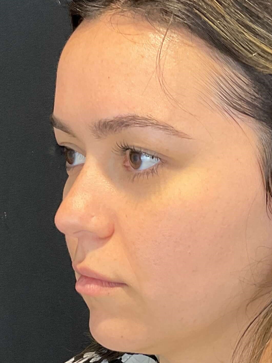Lip filler Before