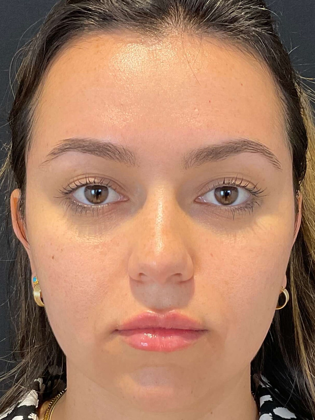 Lip filler After