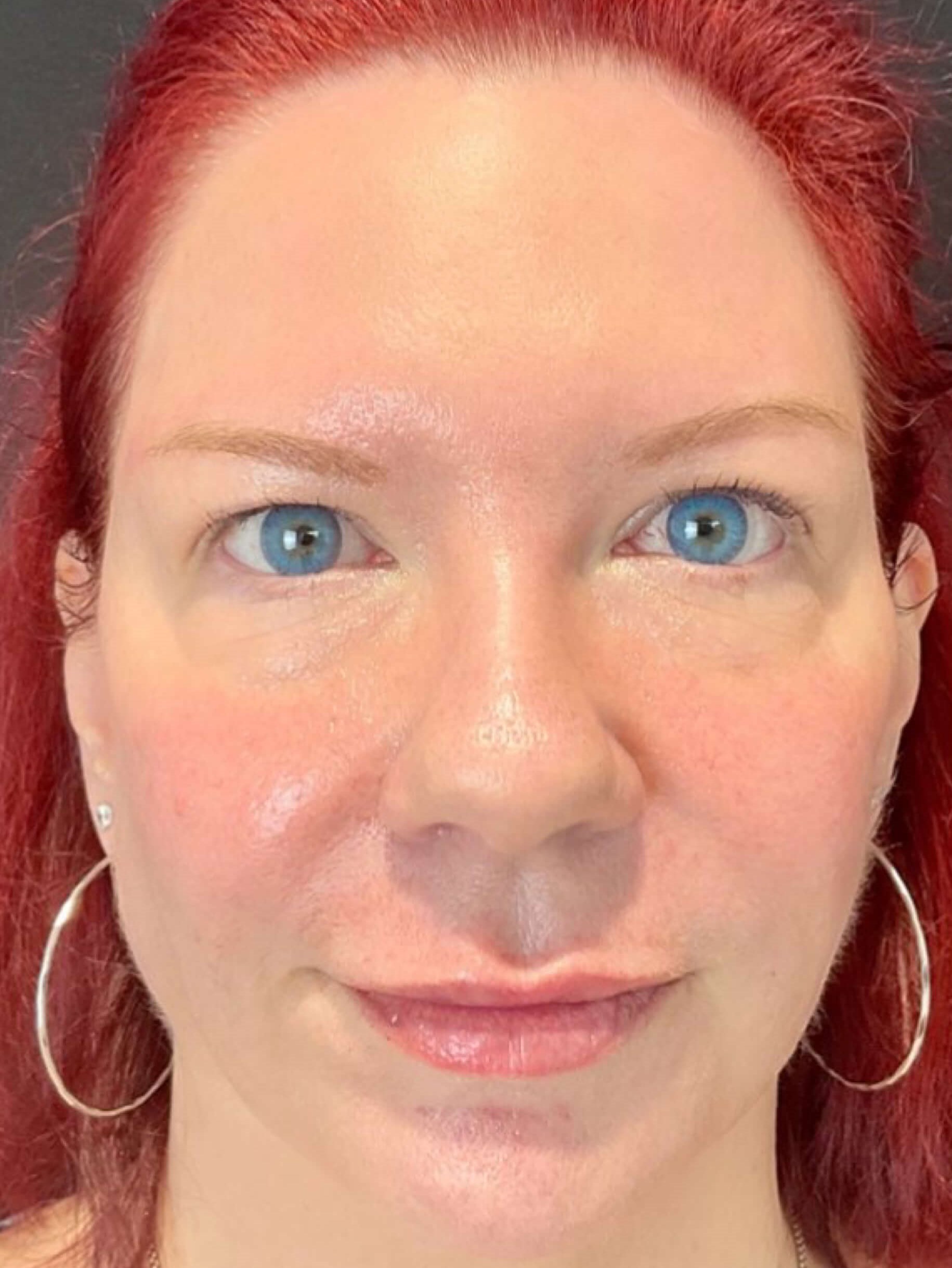 Sculptra After