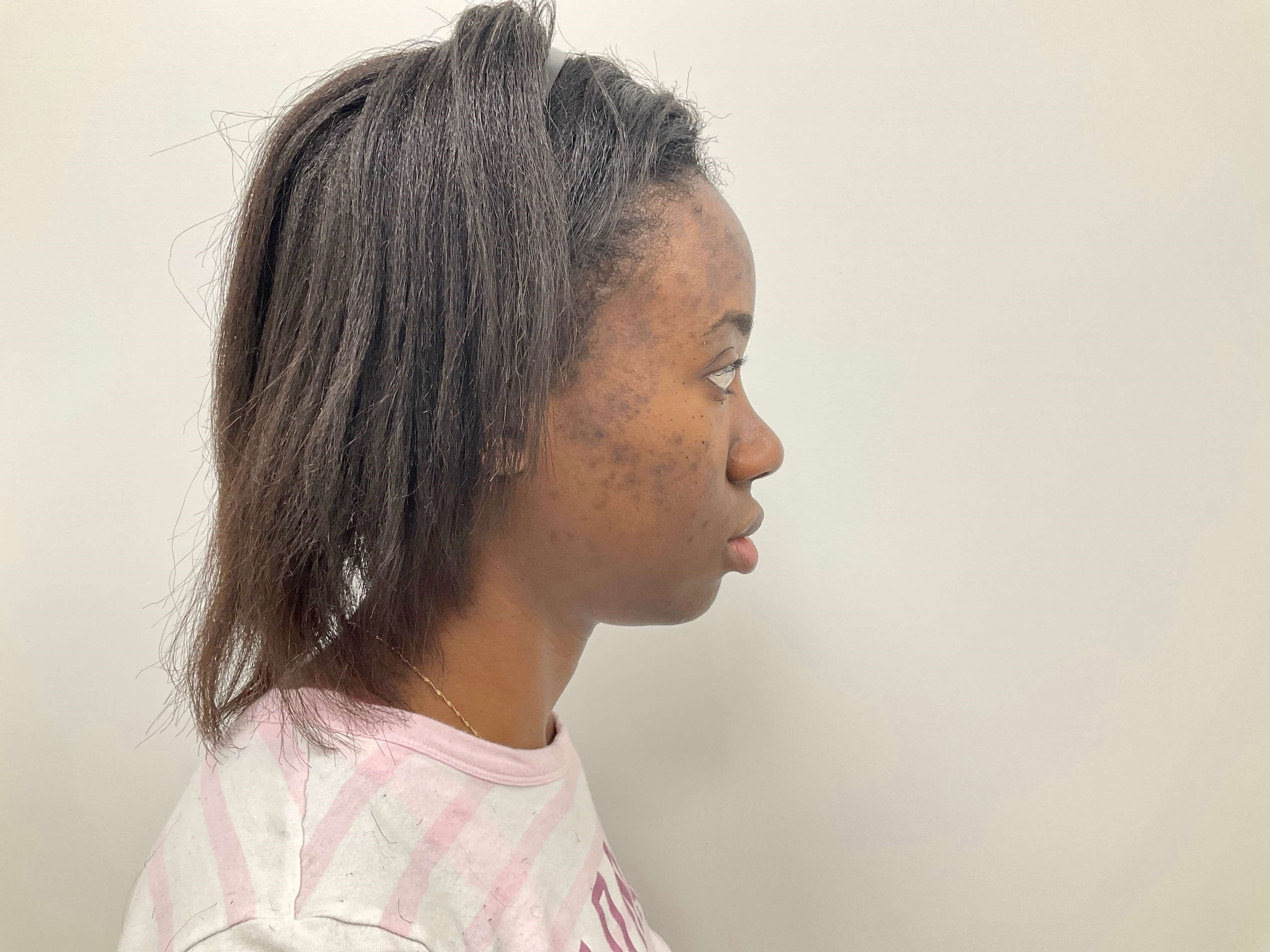 Acne and Hyperpigmentation Before