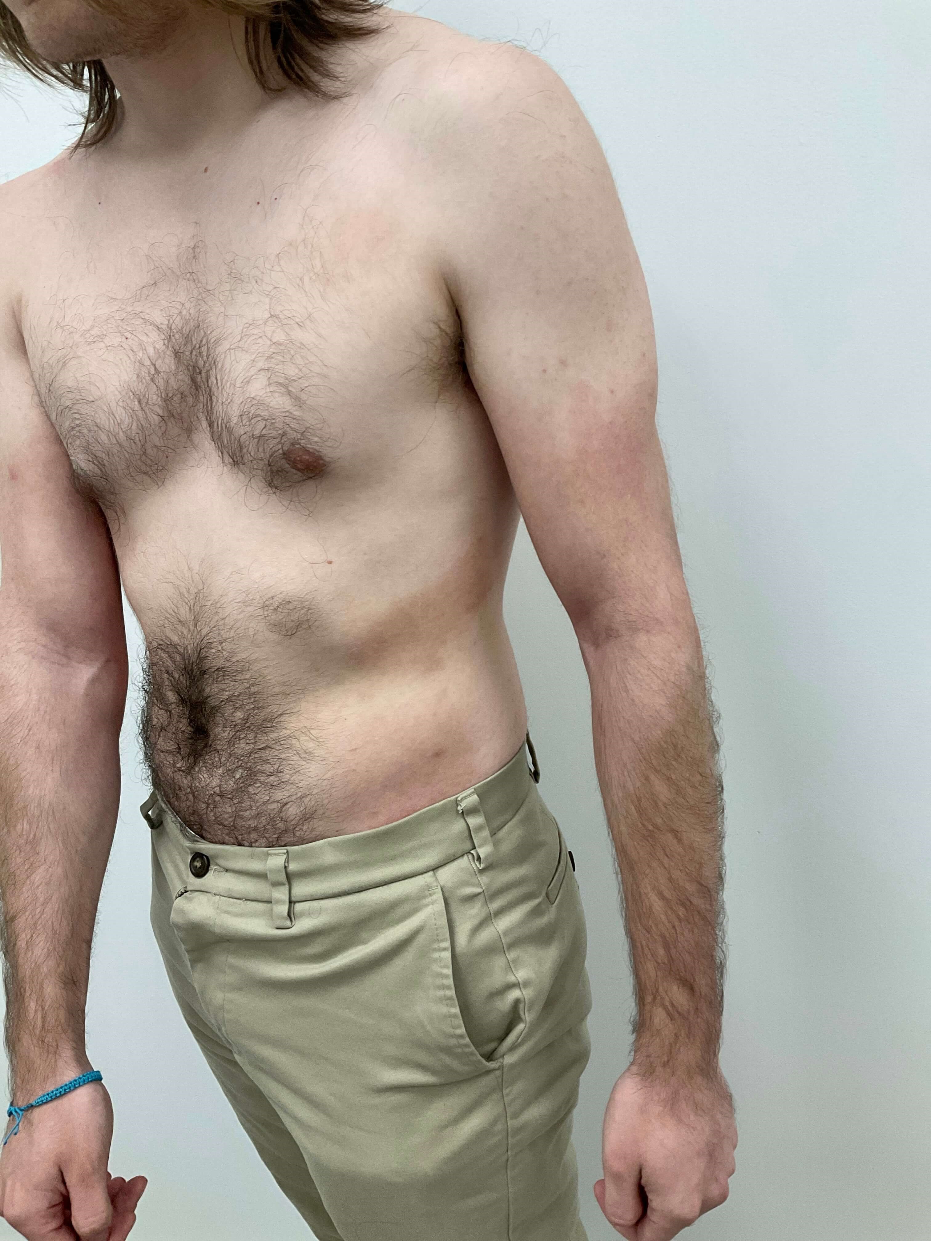 Eczema/Atopic dermatitis After