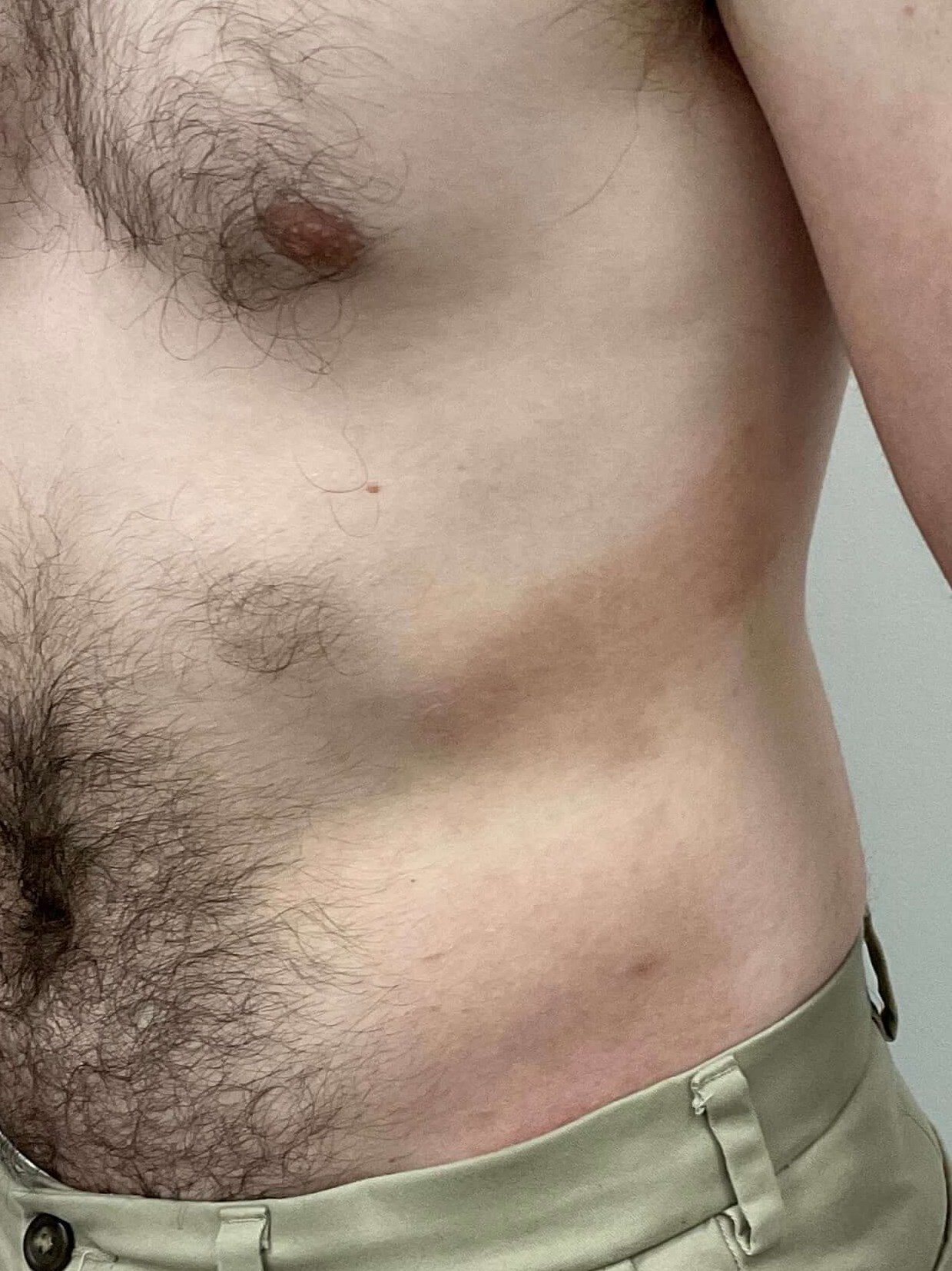 Eczema/Atopic dermatitis After