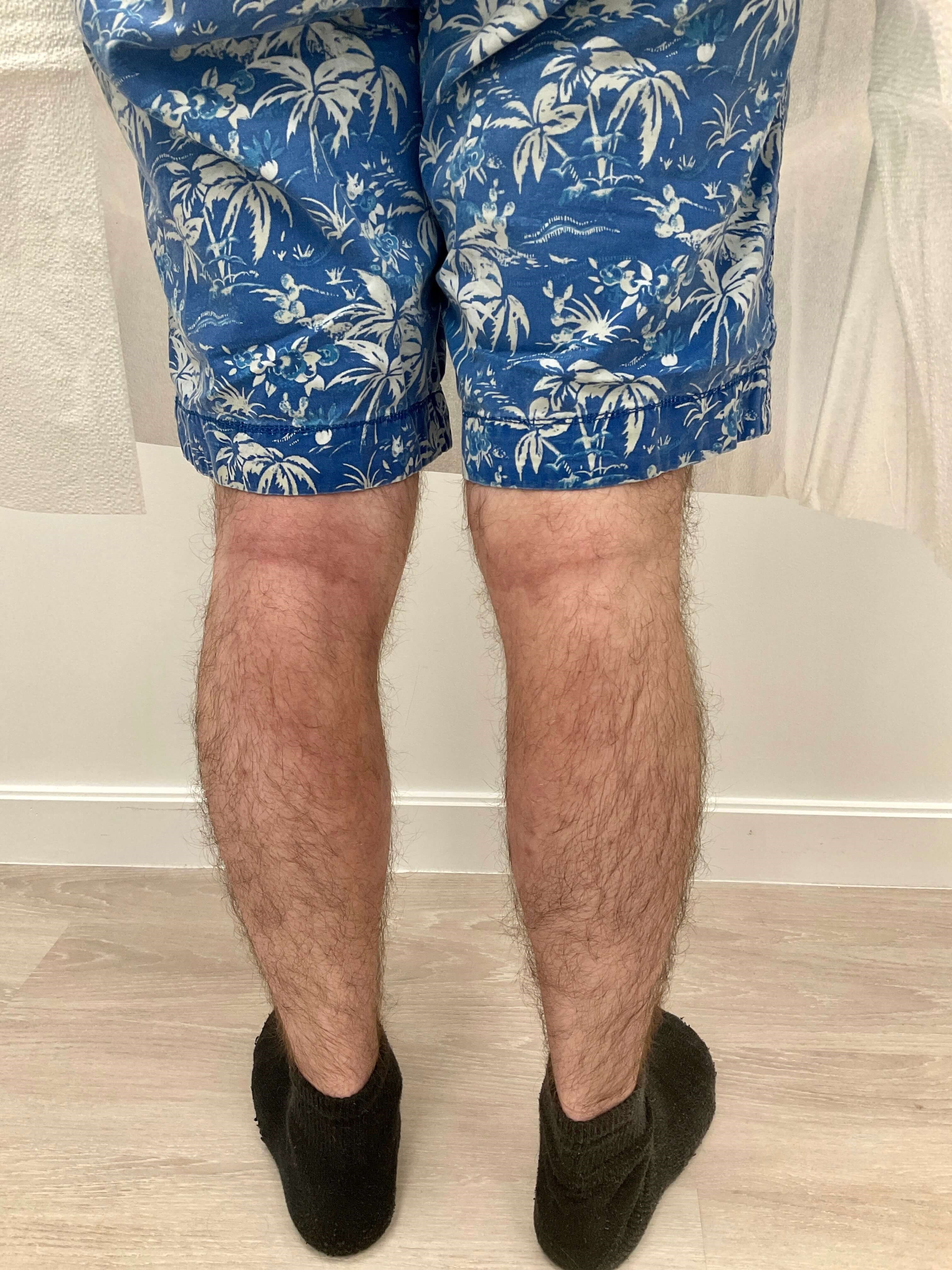 Eczema/Atopic dermatitis After