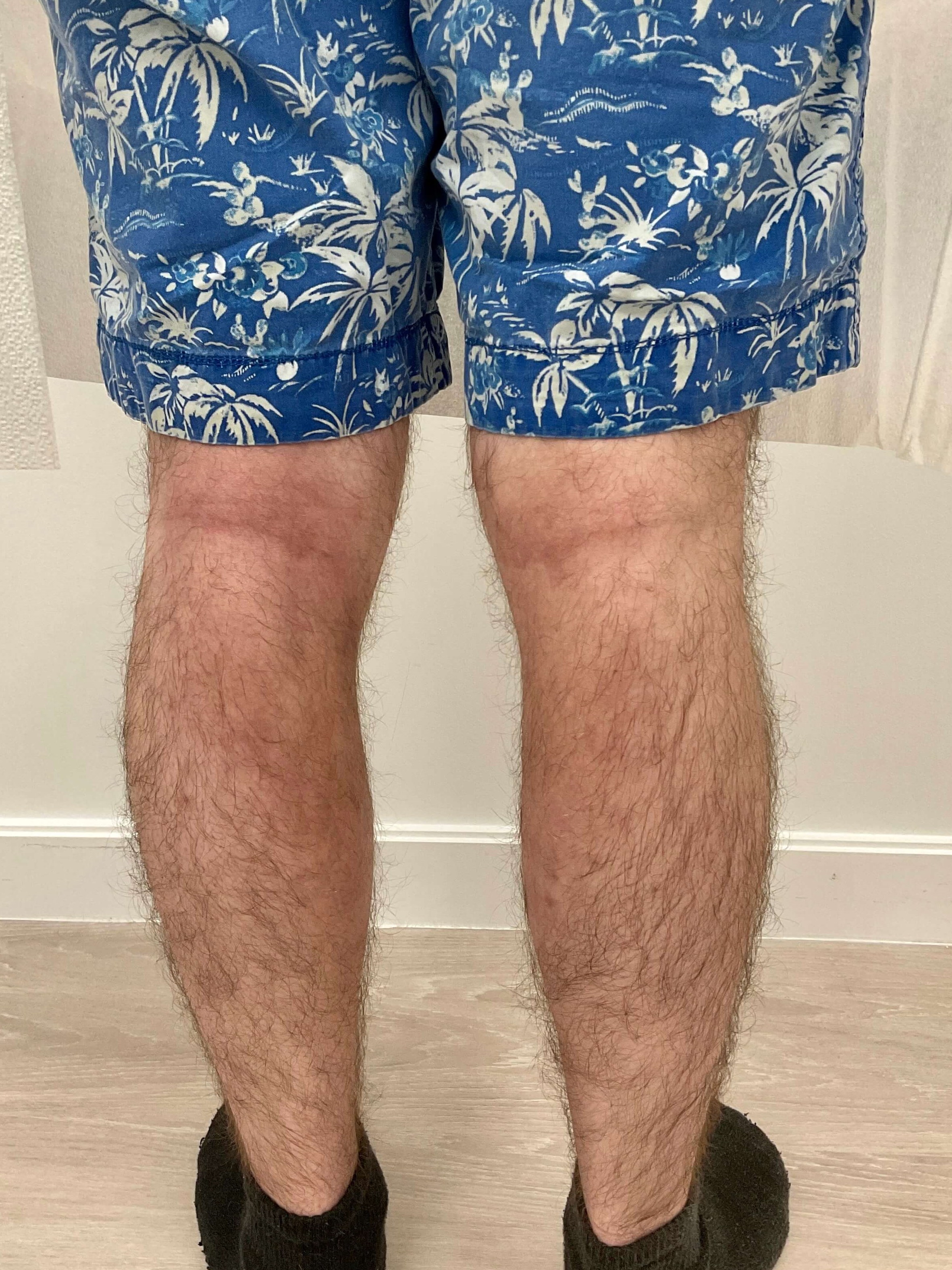 Eczema/Atopic dermatitis After