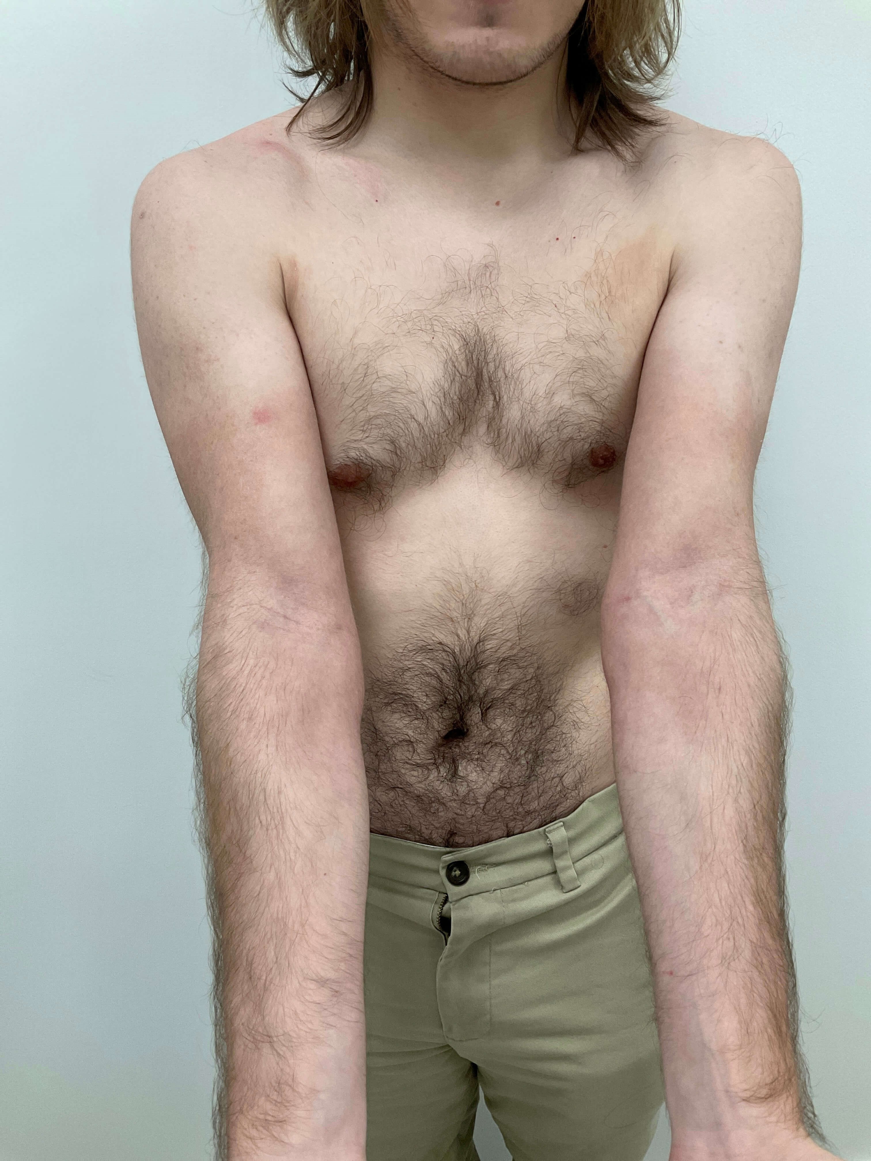 Eczema/Atopic dermatitis After
