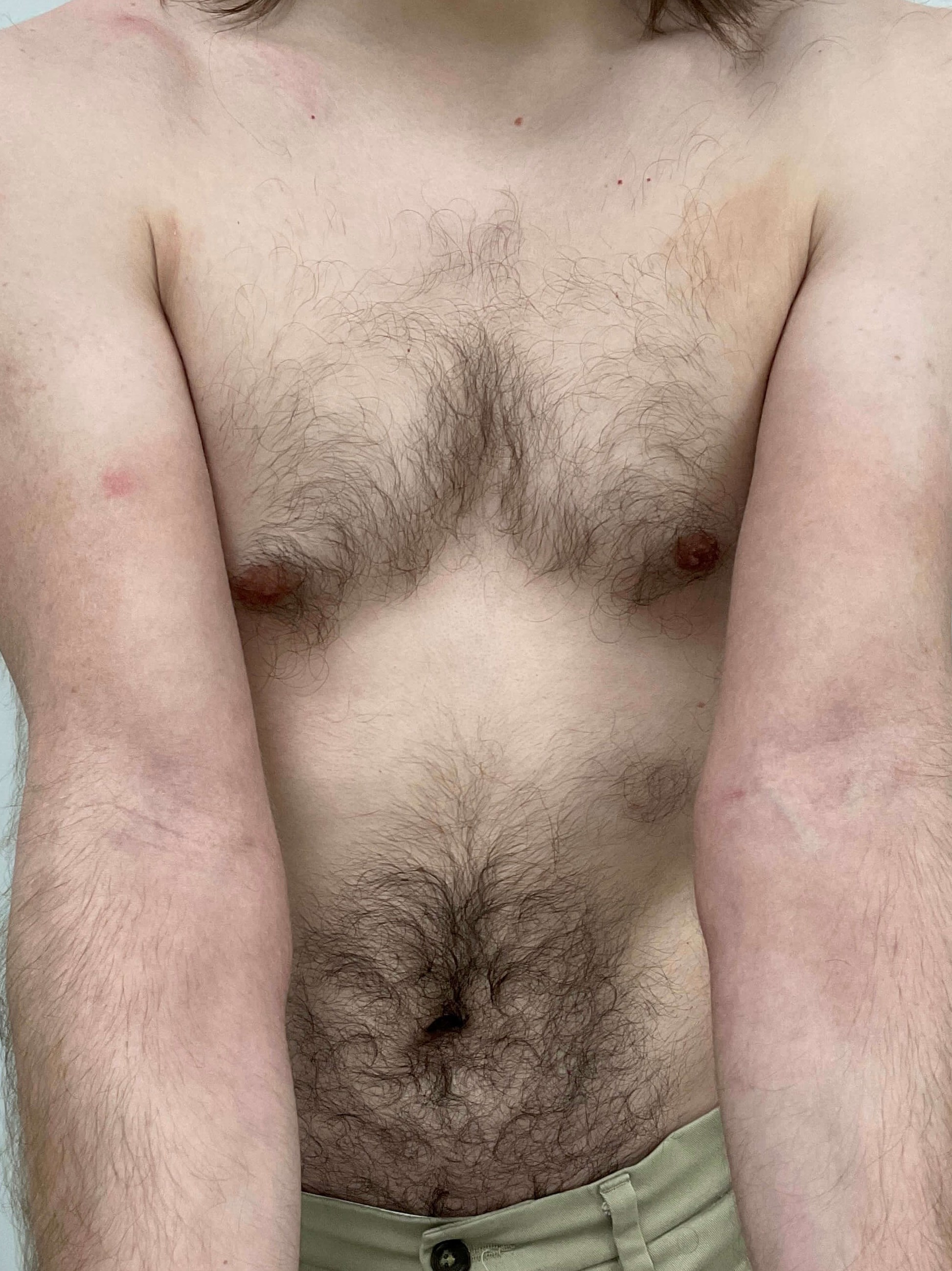 Eczema/Atopic dermatitis After