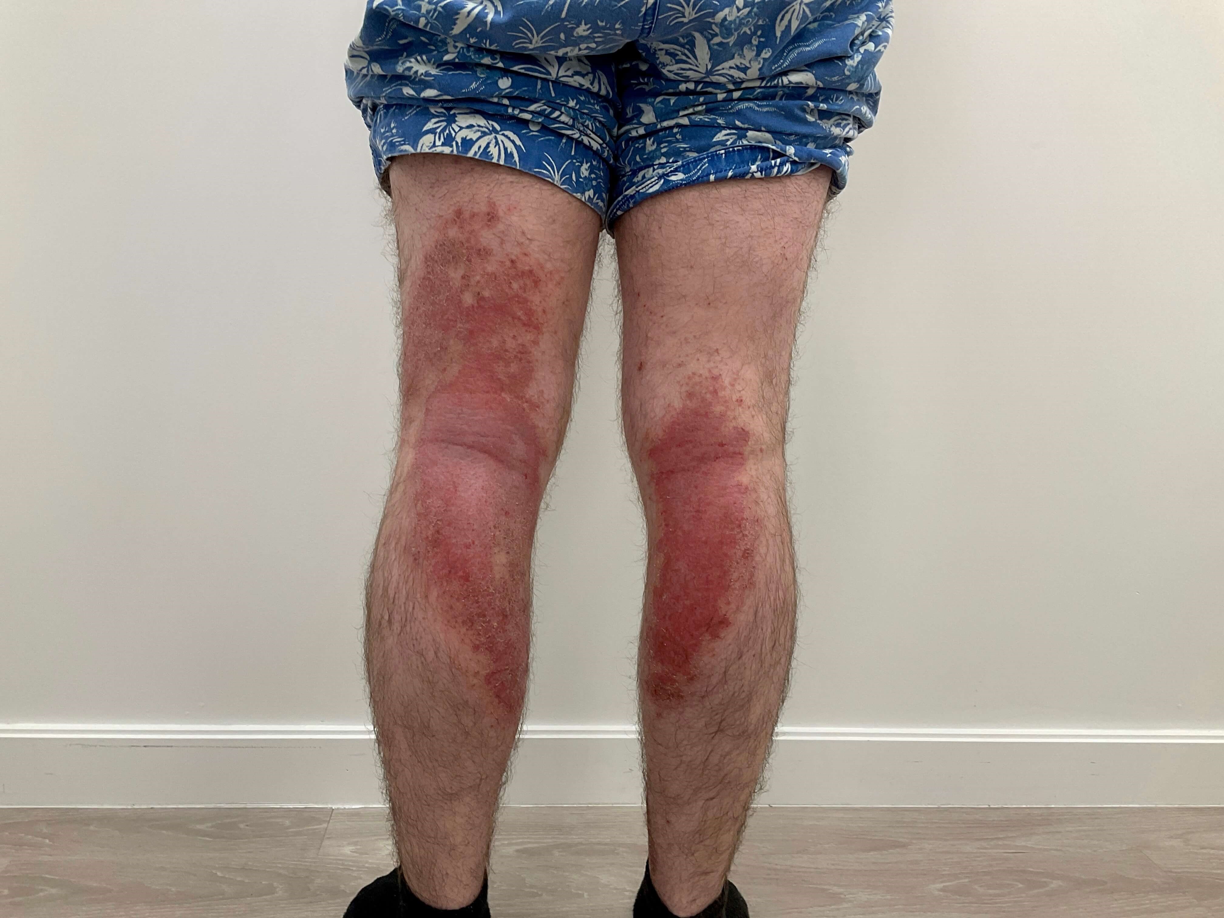 Eczema/Atopic dermatitis Before