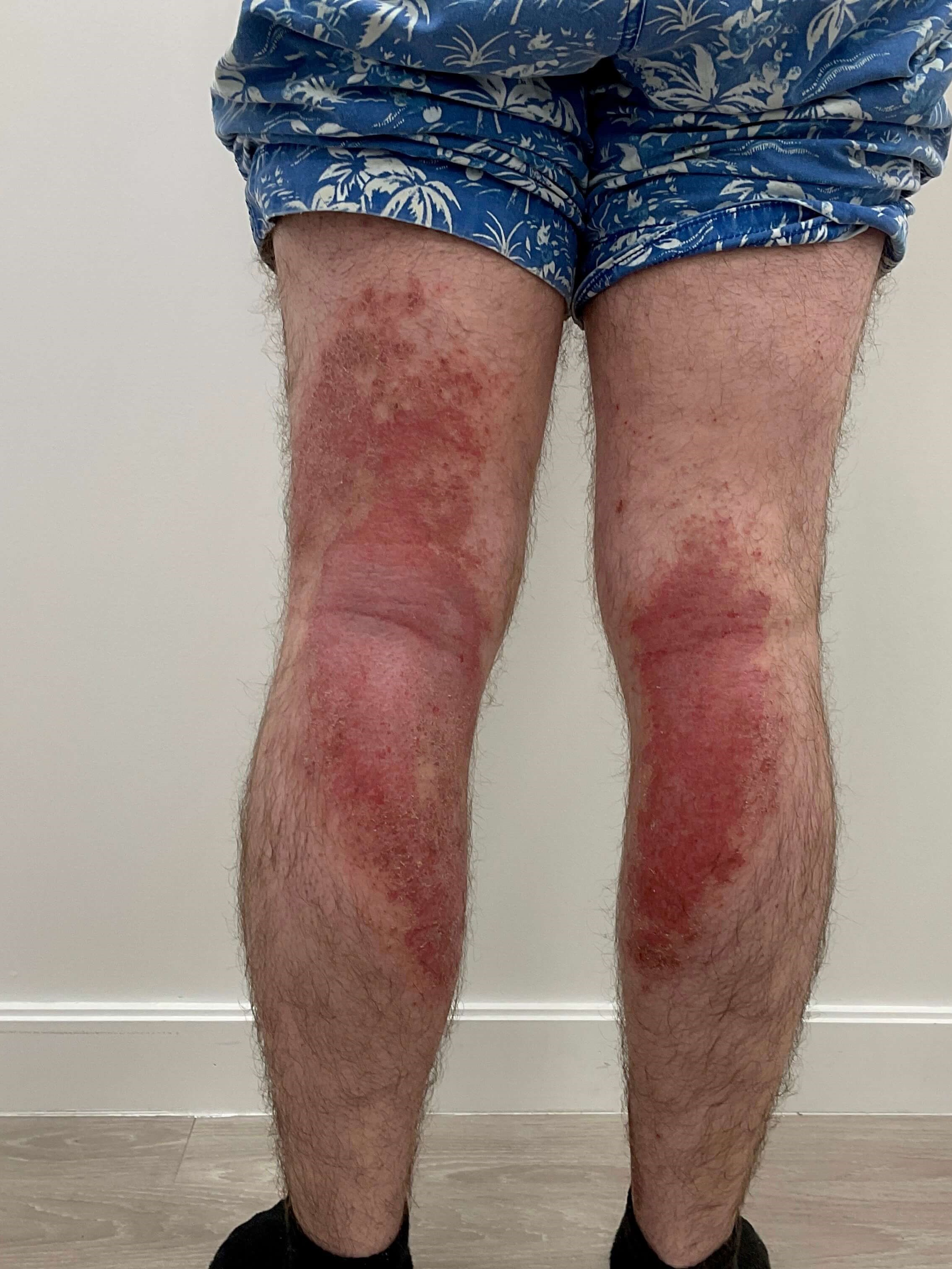 Eczema/Atopic dermatitis Before