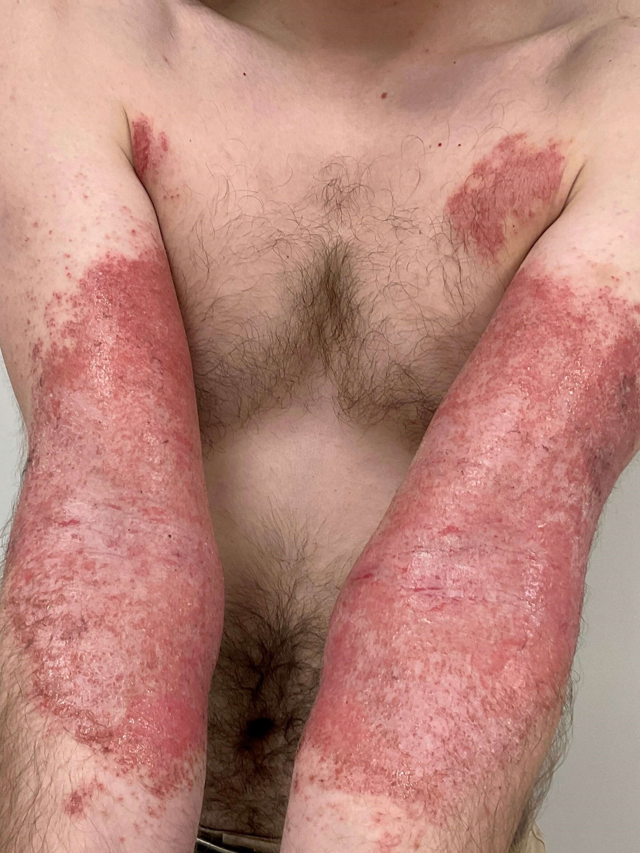Eczema/Atopic dermatitis Before