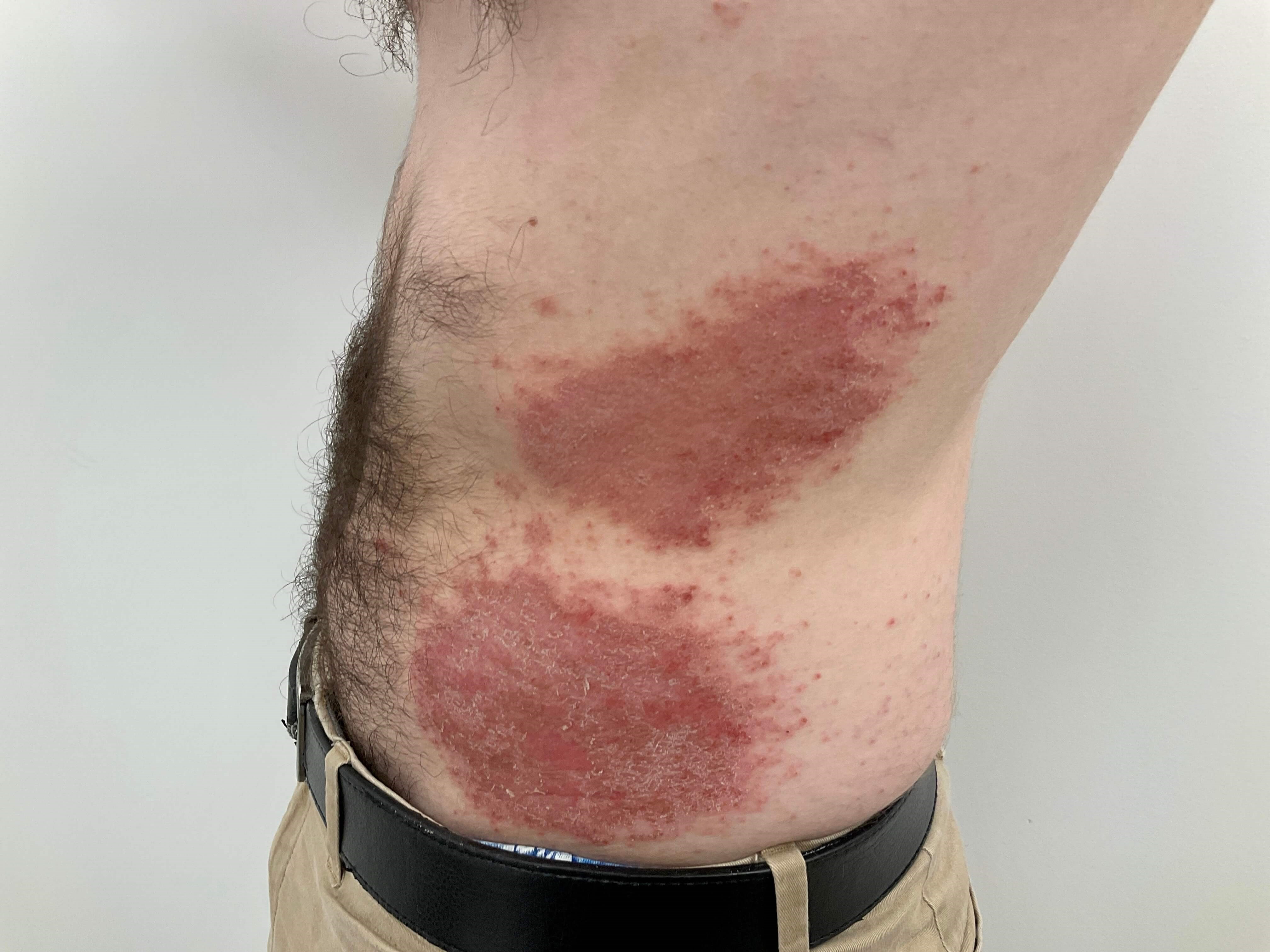 Eczema/Atopic dermatitis Before