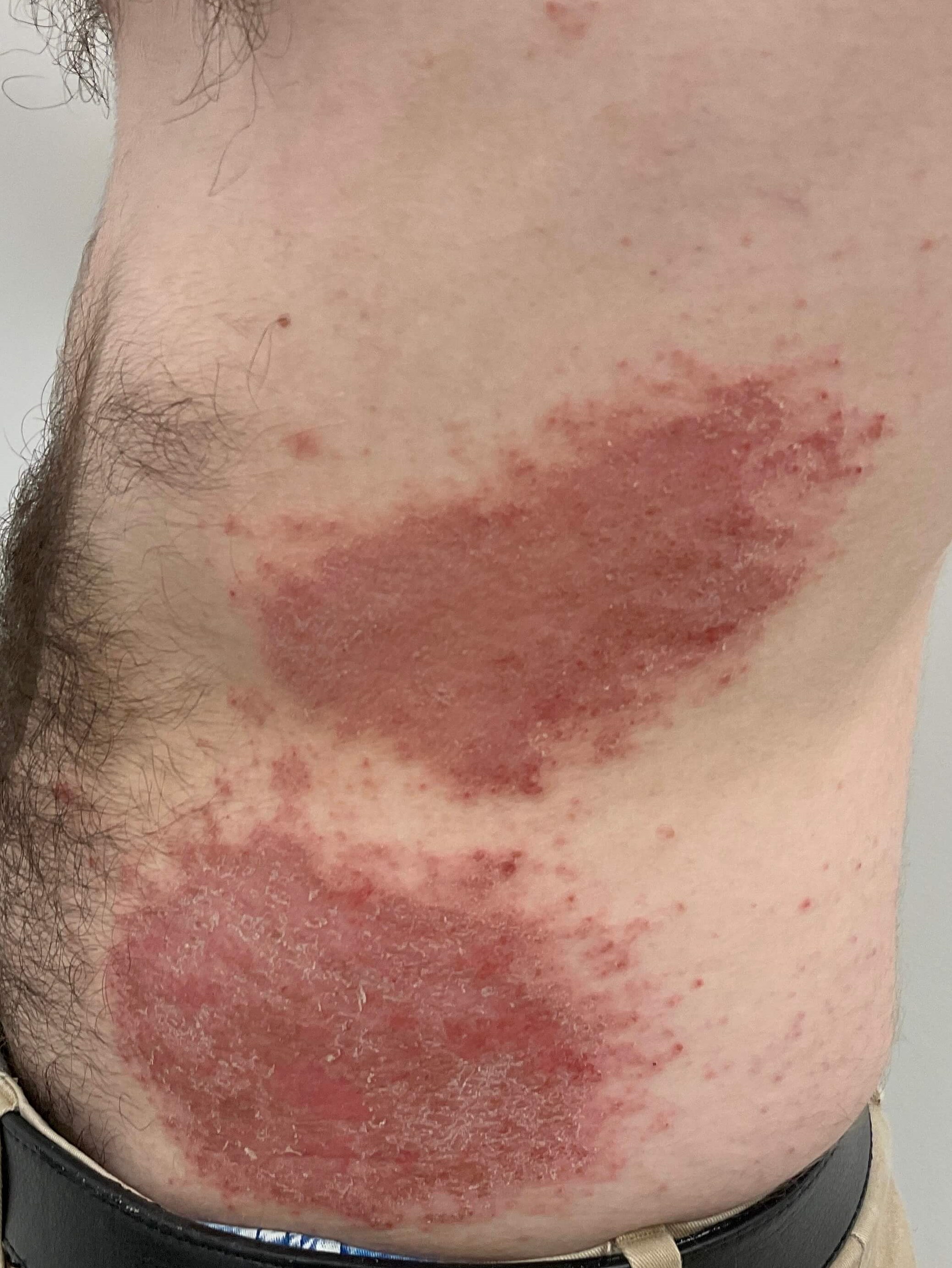 Eczema/Atopic dermatitis Before