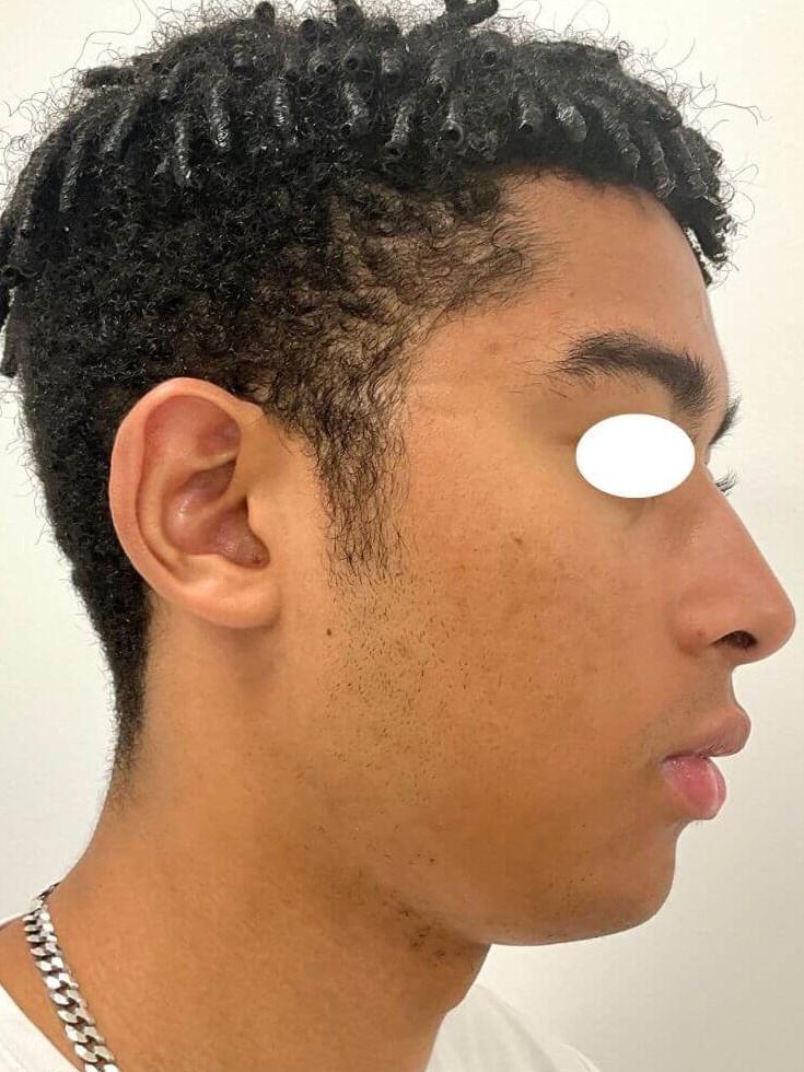 Acne, scars and accutane After