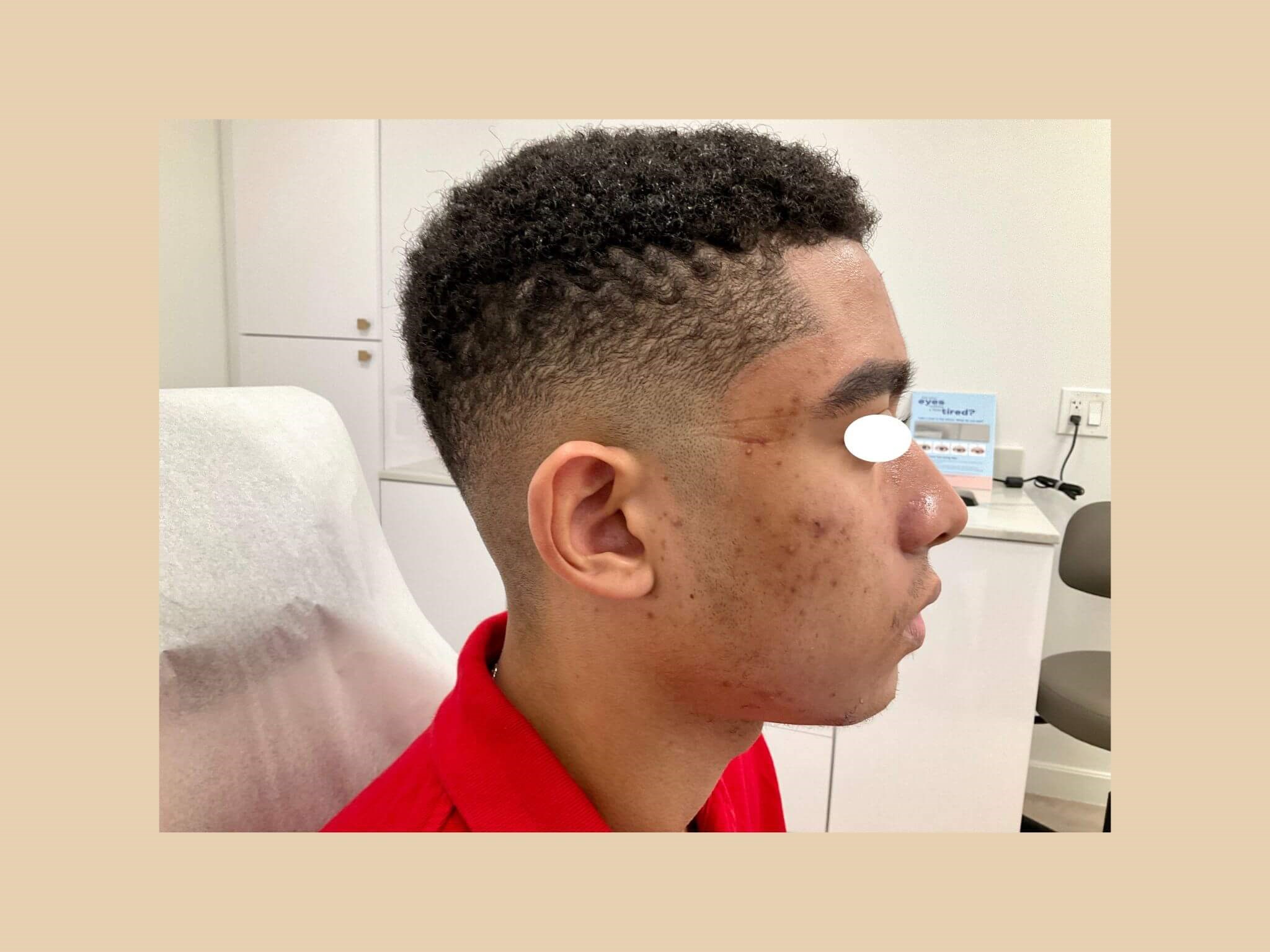 Acne, scars and accutane Before