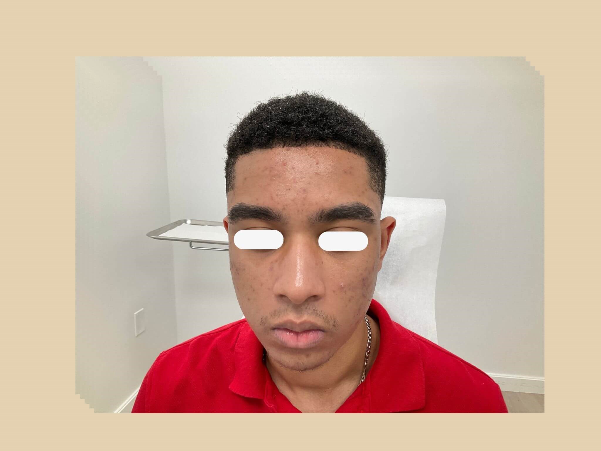 Acne, scars and accutane Before