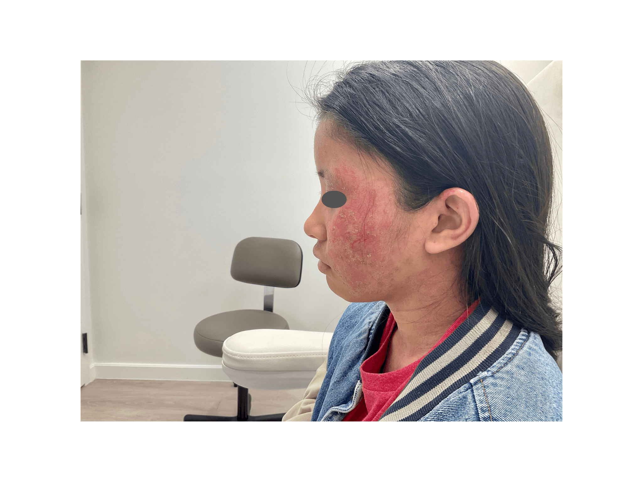 Eczema/Atopic Dermatitis Before