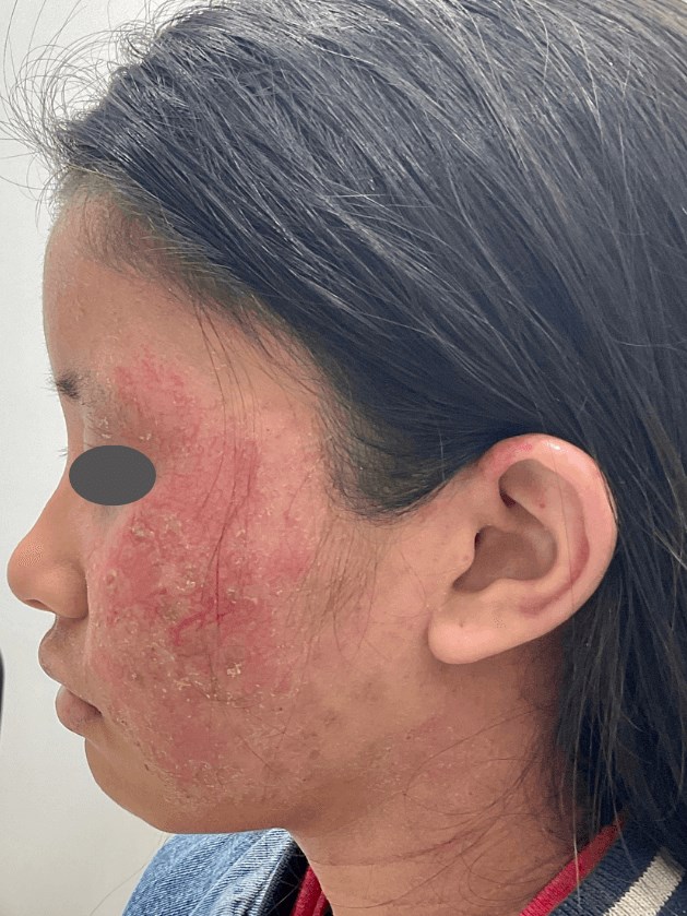 Eczema/Atopic Dermatitis Before