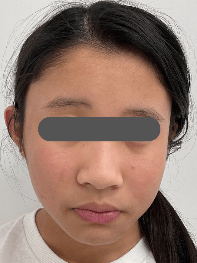Eczema/Atopic Dermatitis After