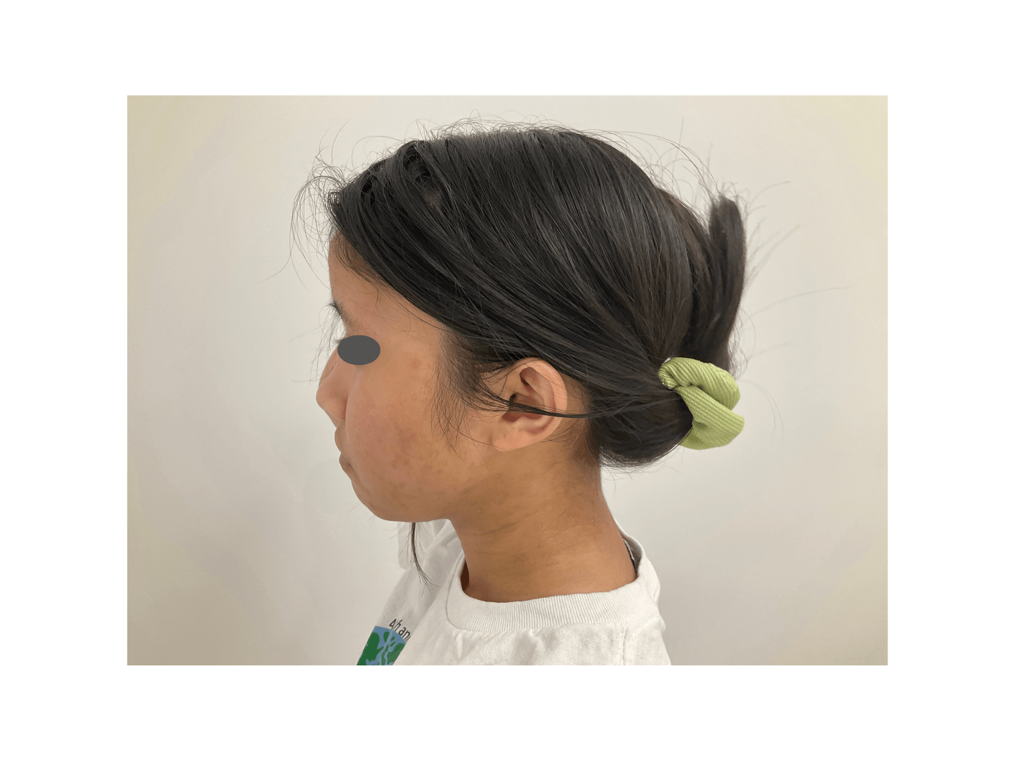 Eczema/Atopic Dermatitis After