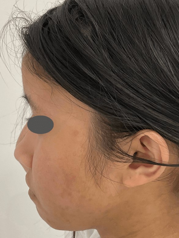 Eczema/Atopic Dermatitis After