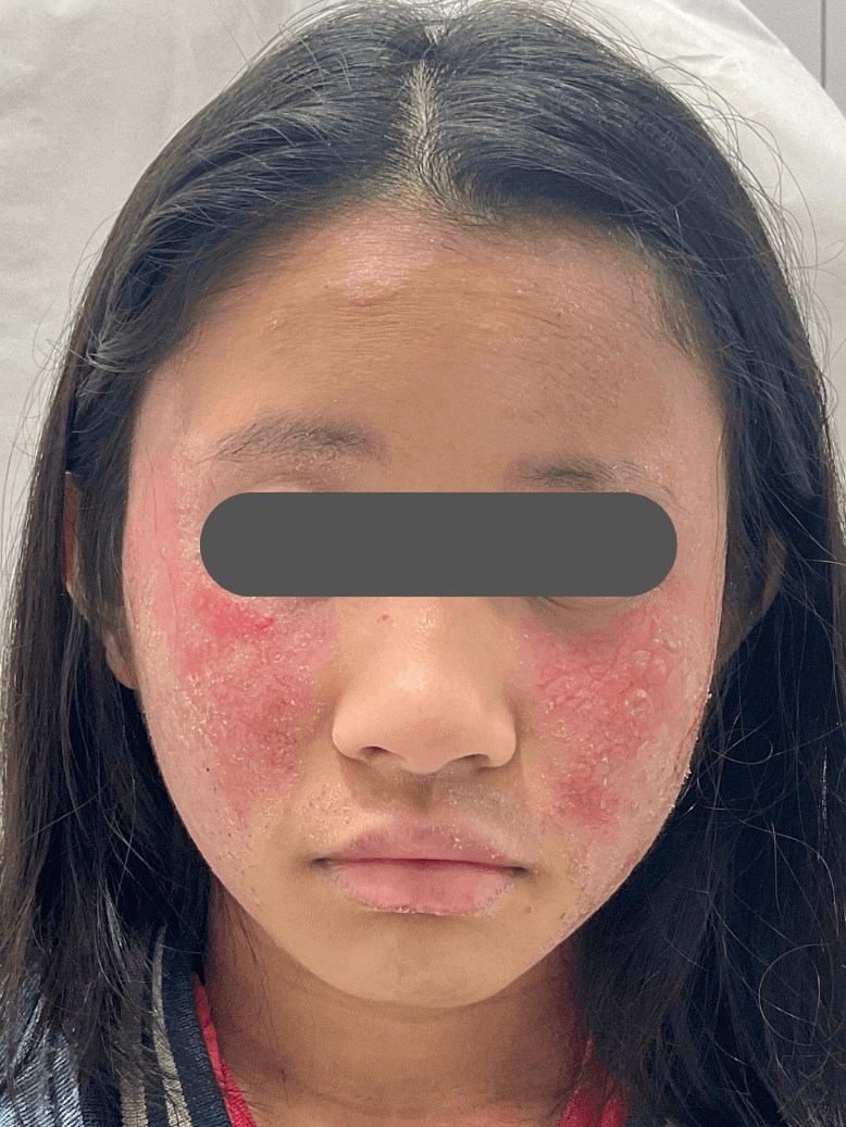 Eczema/Atopic Dermatitis Before