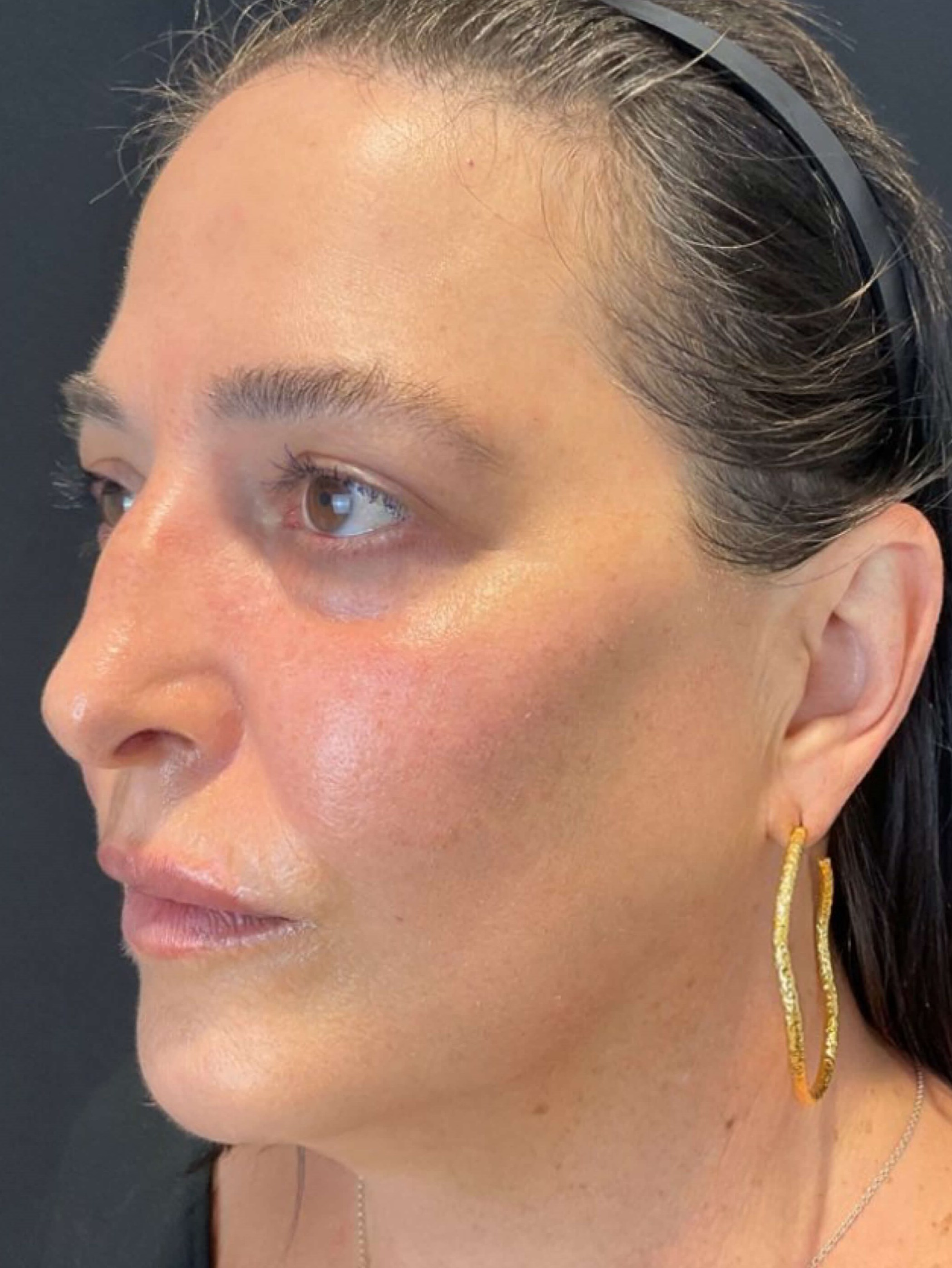 Sculptra biostimulatory filler After