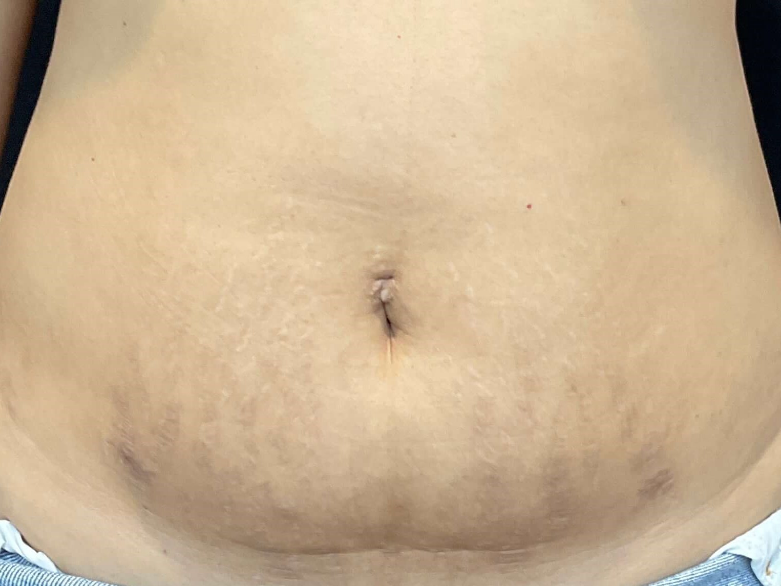 Stretch marks After
