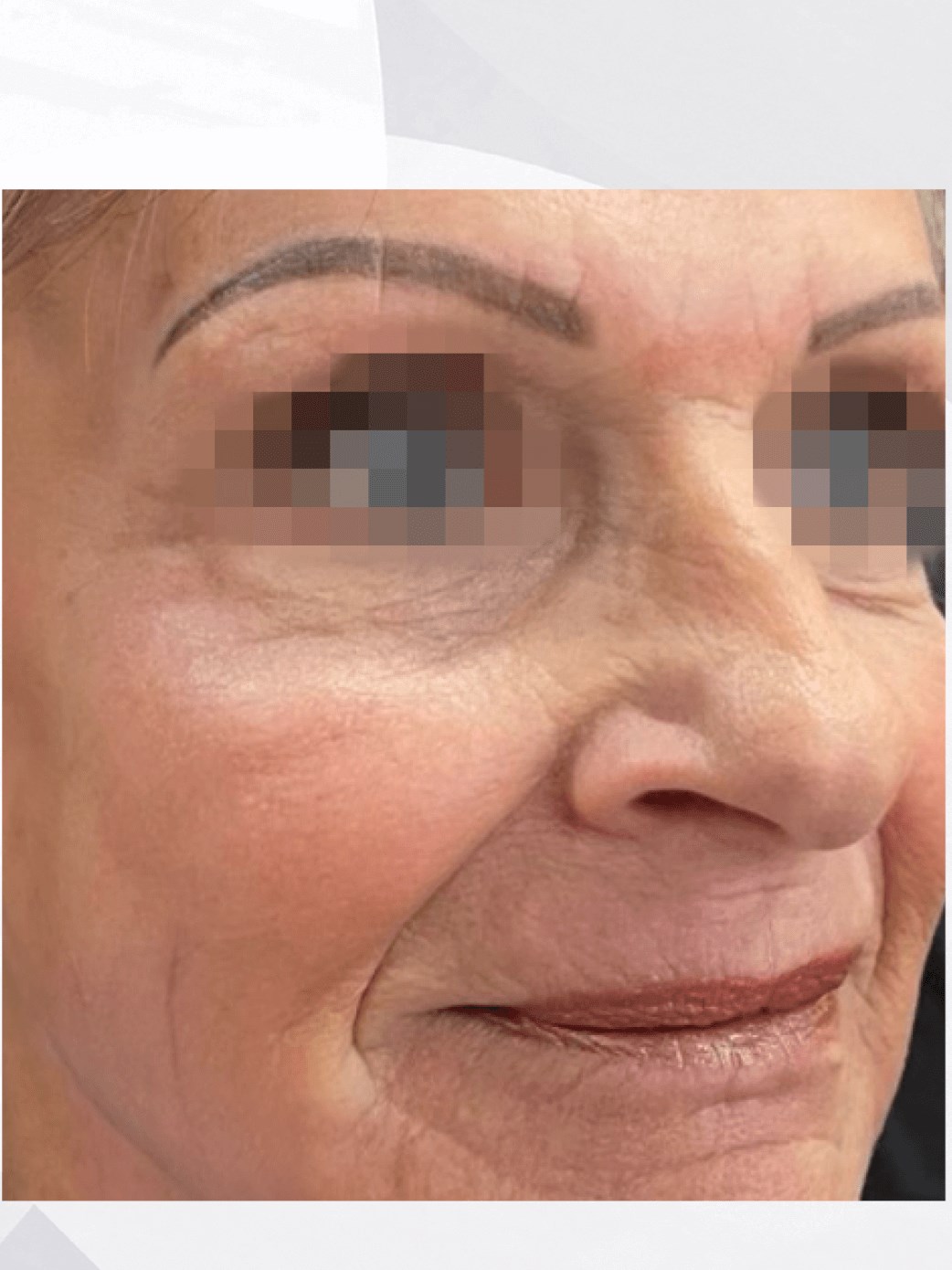 LASER PEEL After