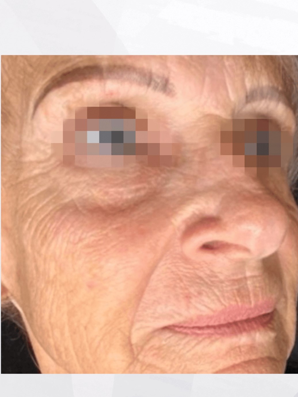 LASER PEEL Before