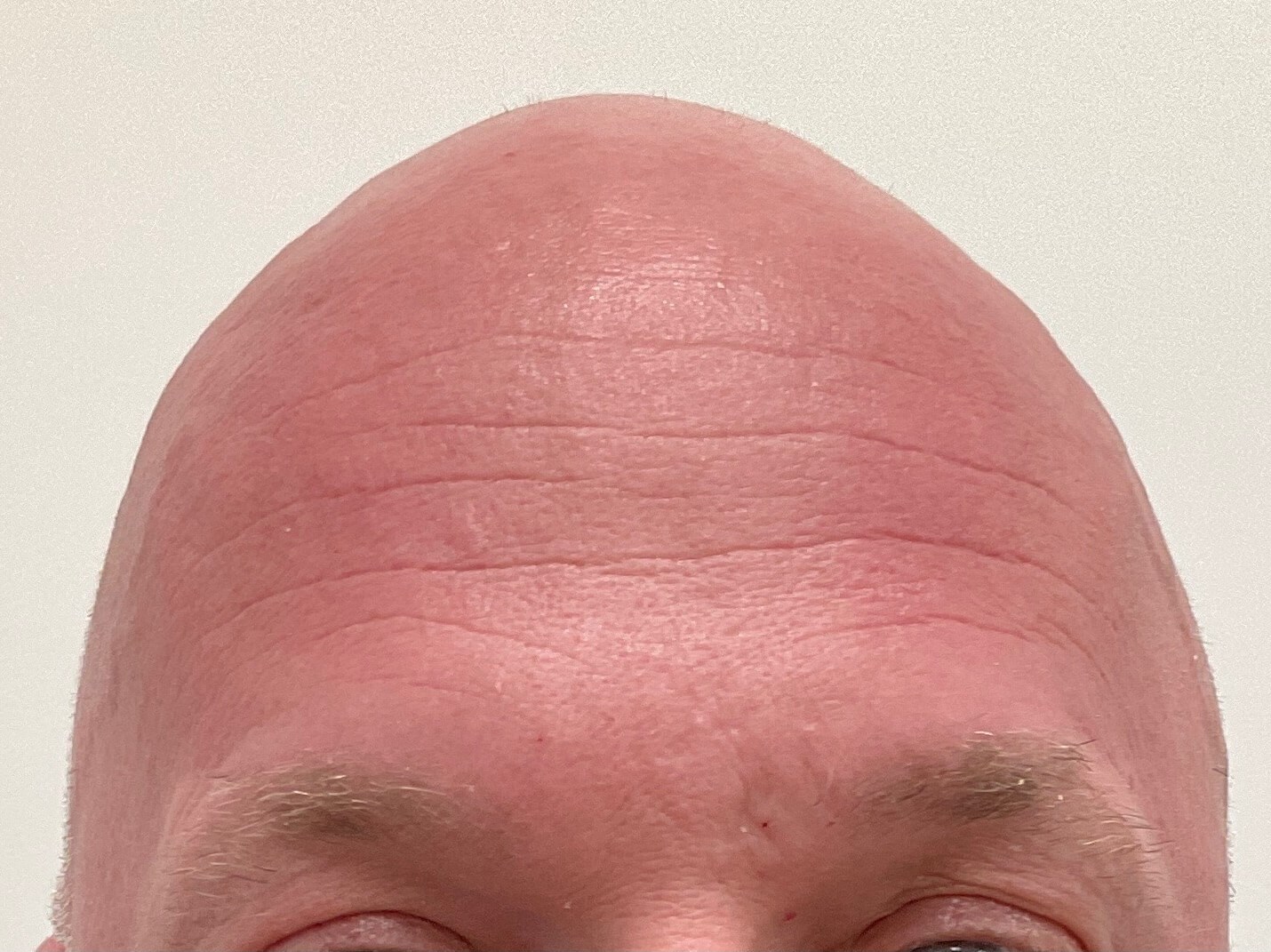 Botox Treatment - 50 yo male Before