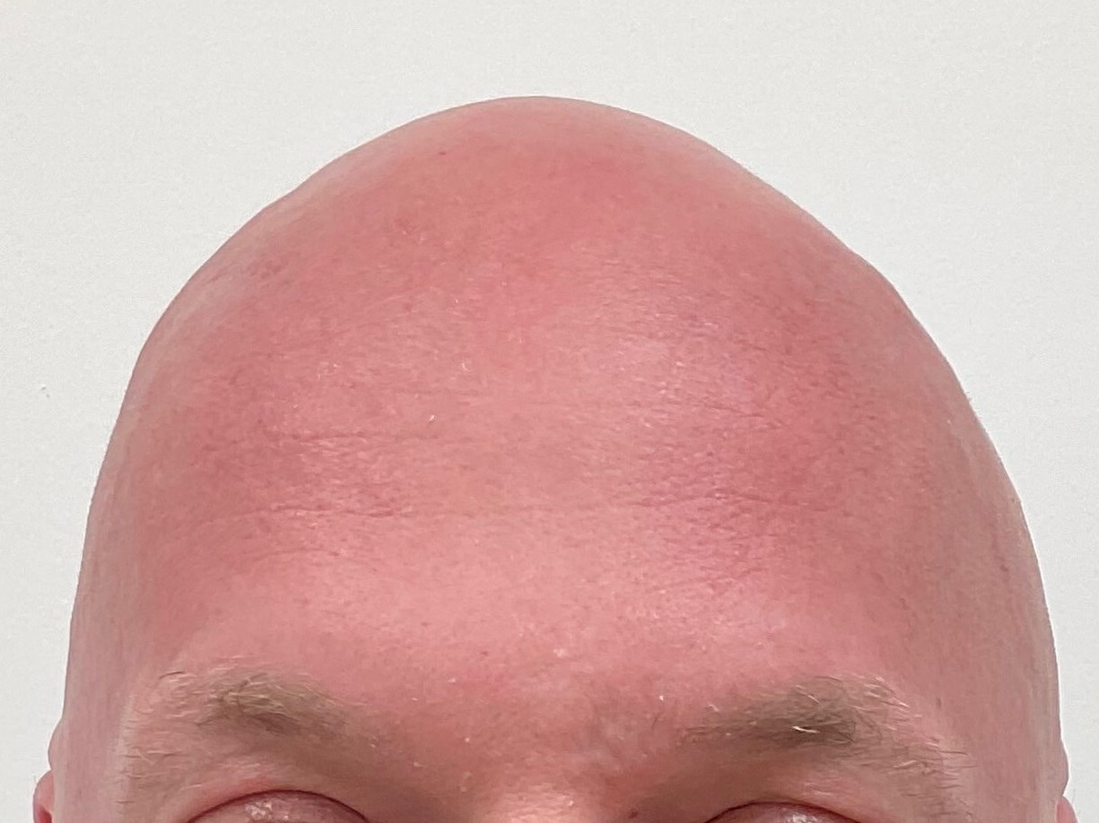 Botox Treatment - 50 yo male After