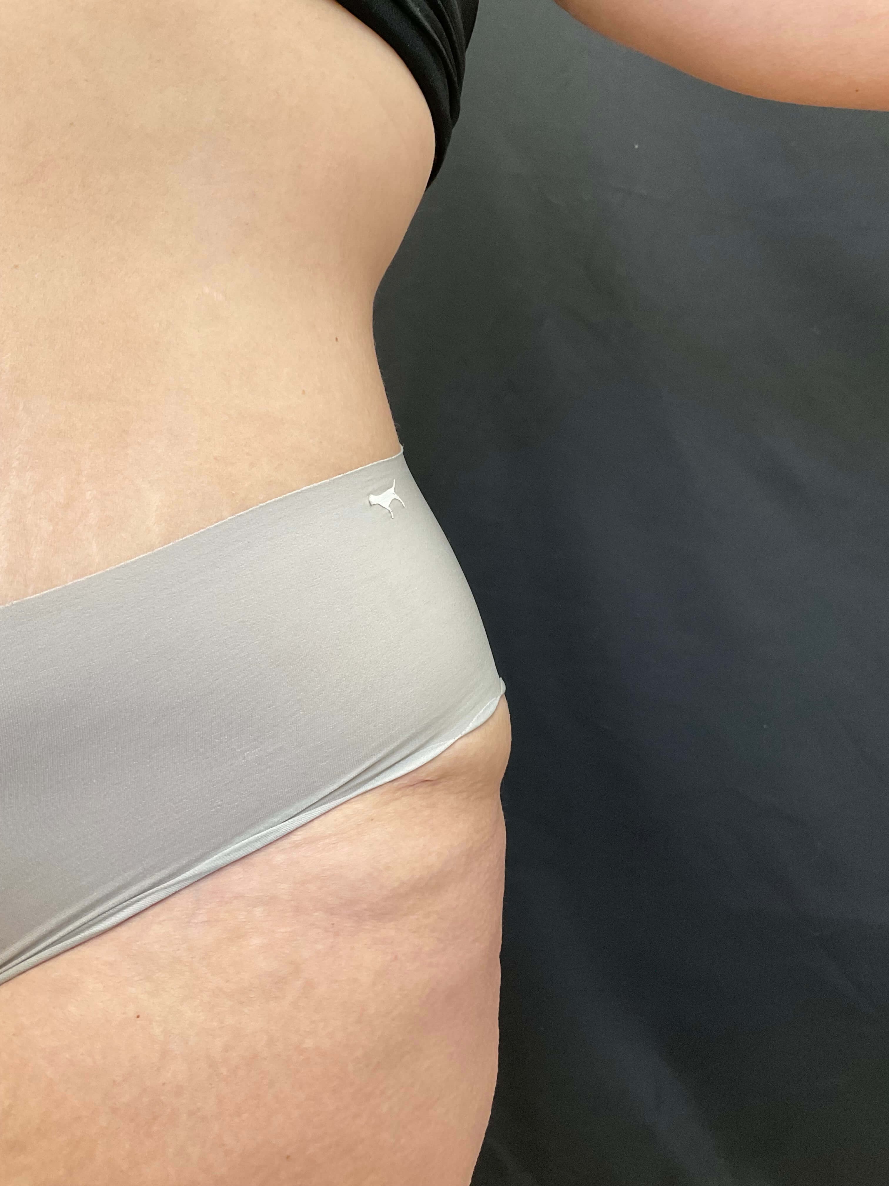 Body sculpt with EvolveX Before