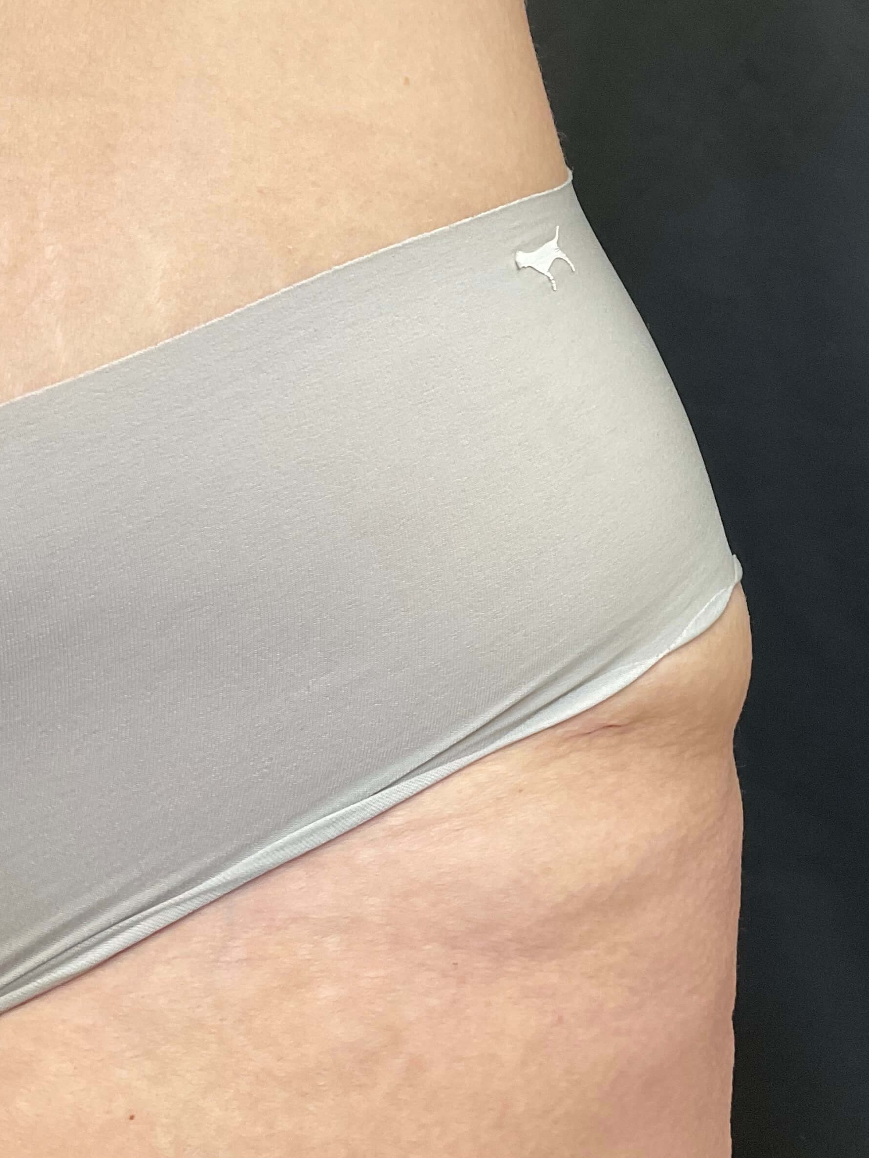 Body sculpt with EvolveX Before