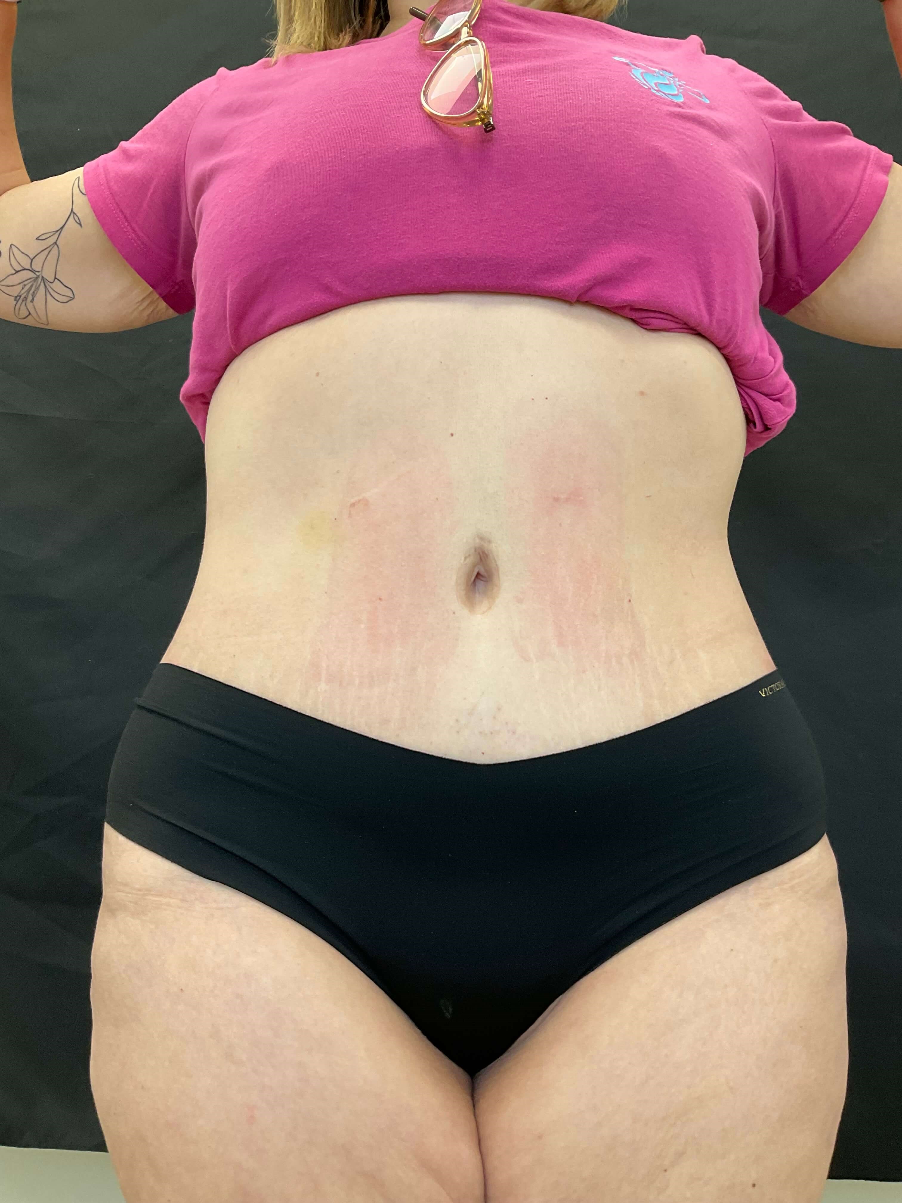 Body sculpt with EvolveX After
