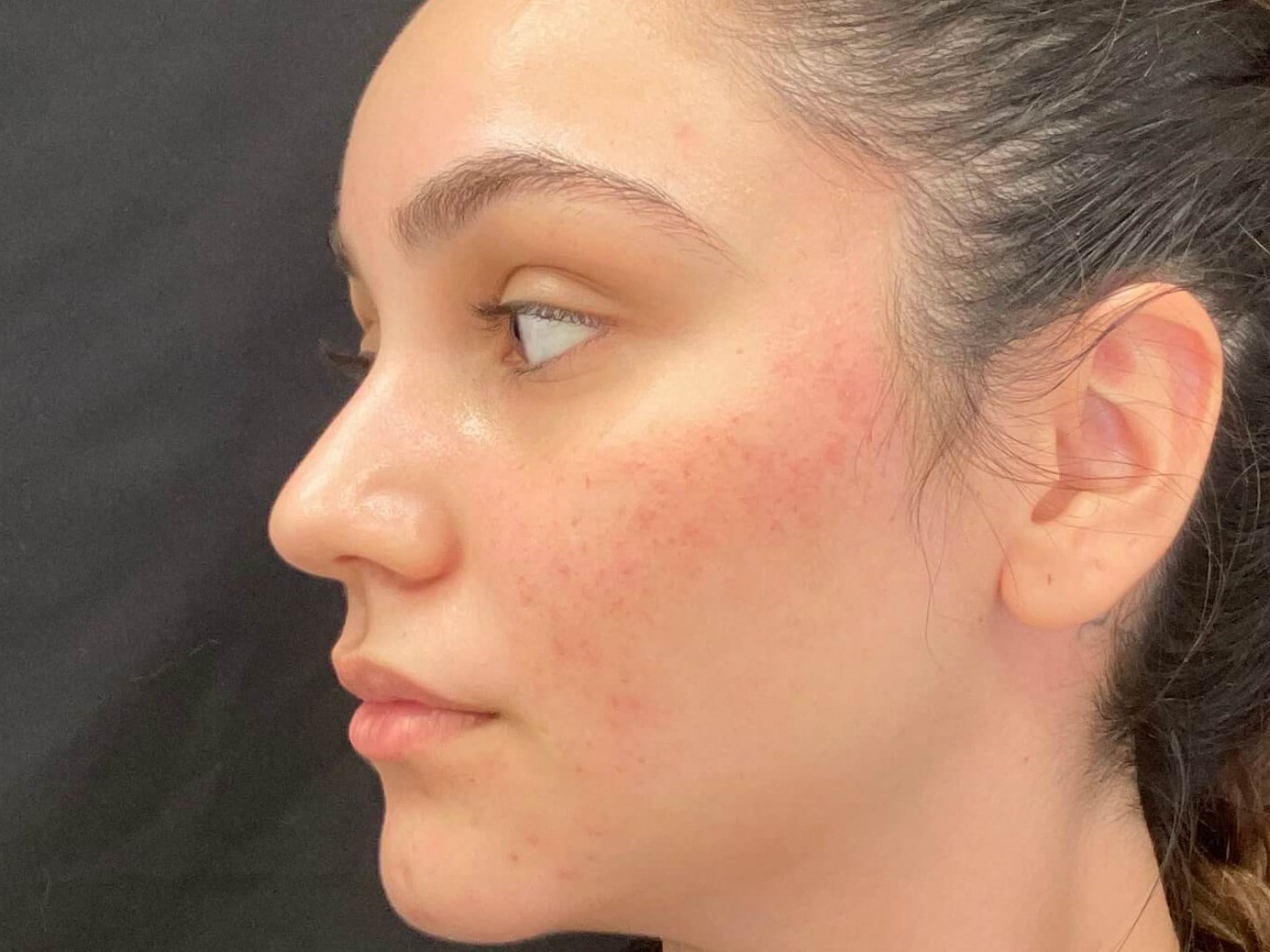IPL LUMECCA LASER ROSACEA ACNE After