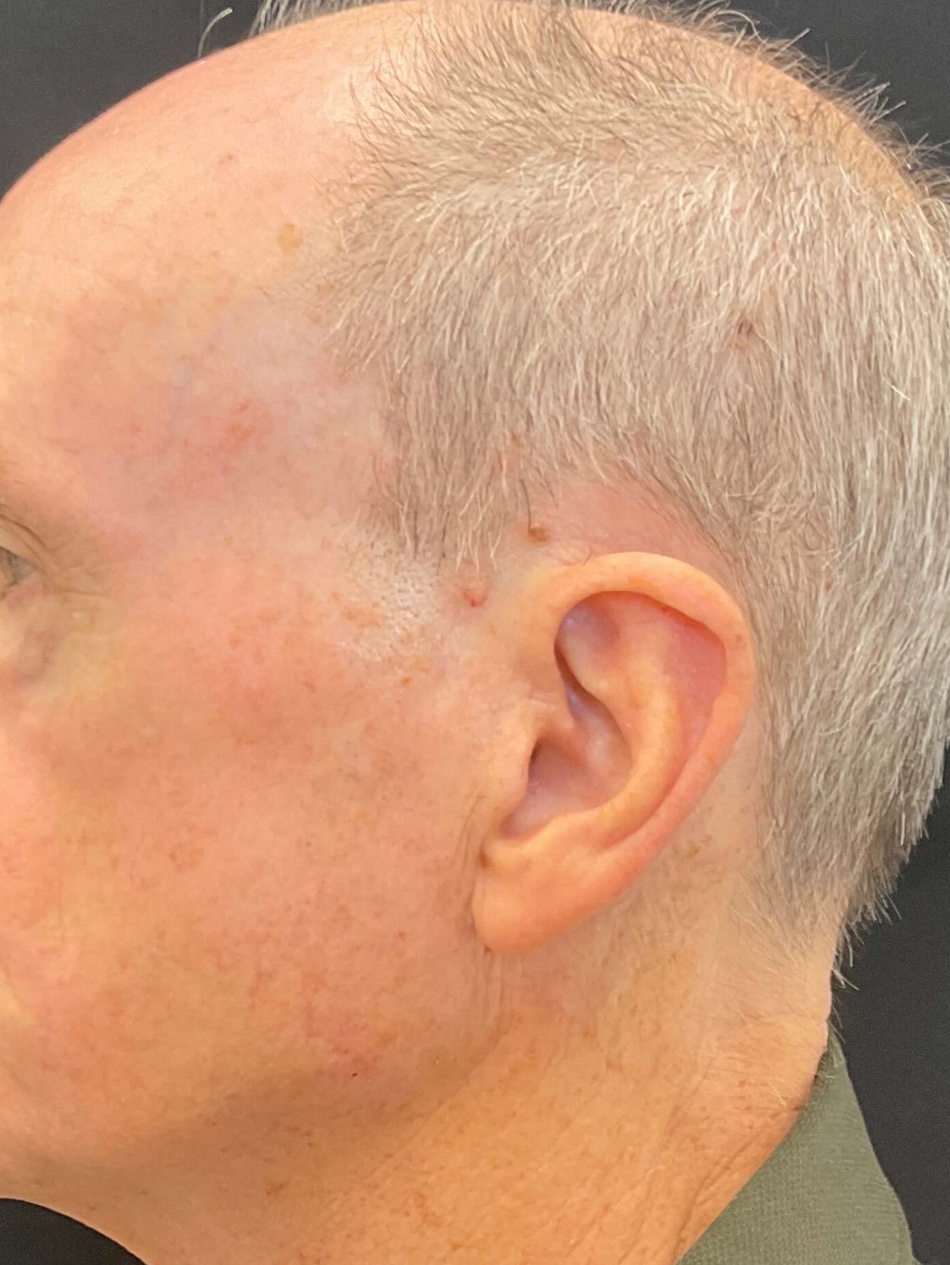 Seborrheic Keratosis After