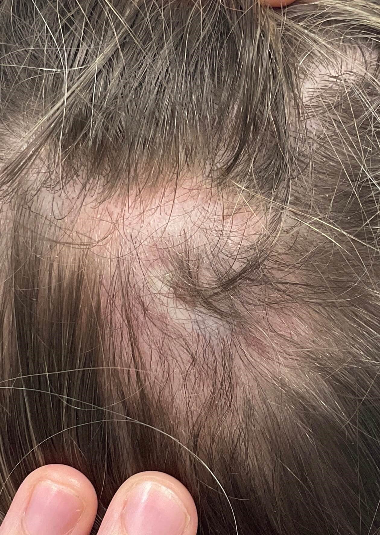 Hair loss After
